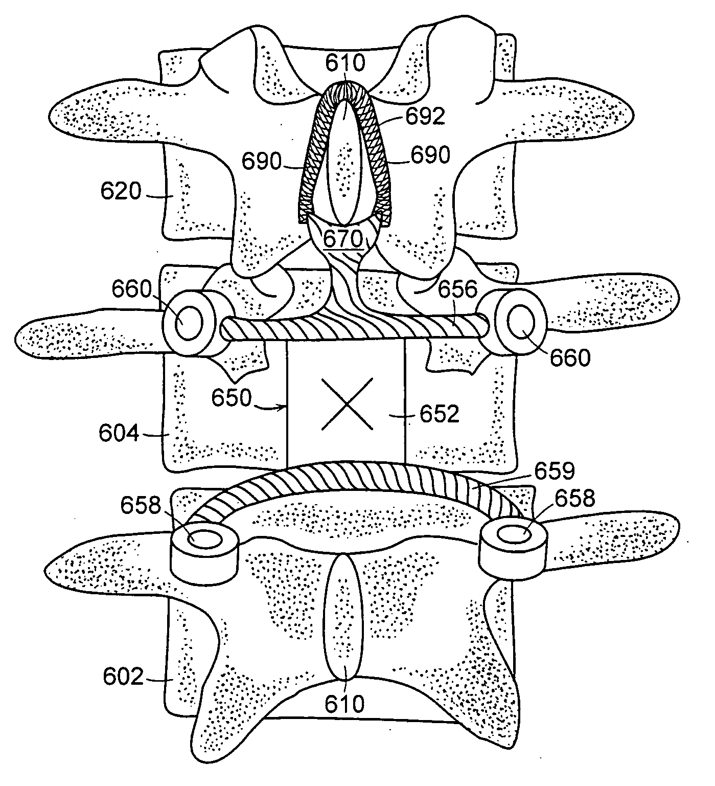 Facet joint and spinal ligament replacement