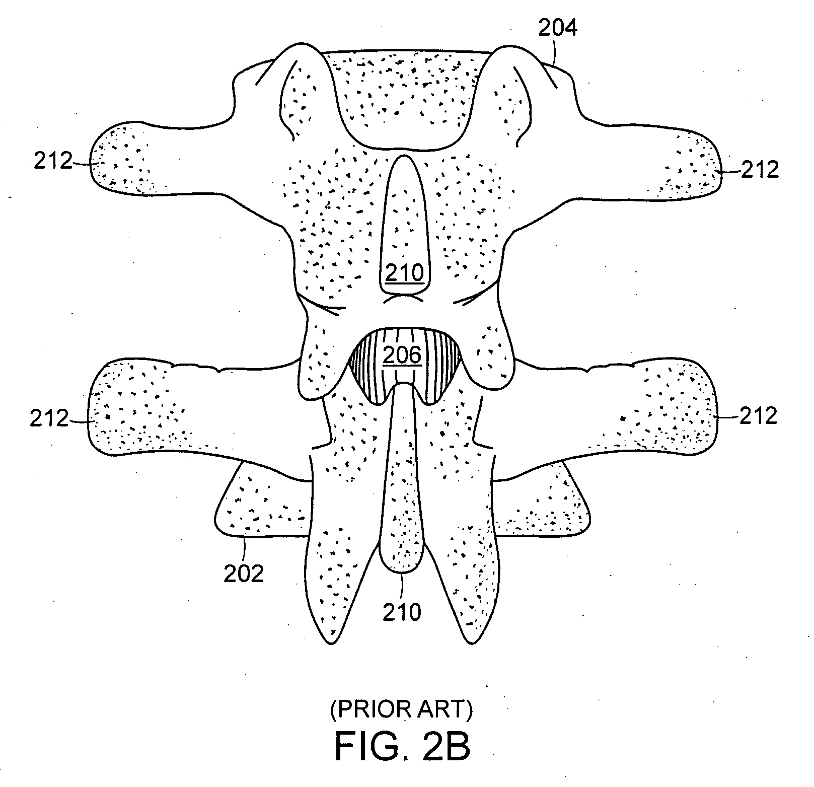 Facet joint and spinal ligament replacement