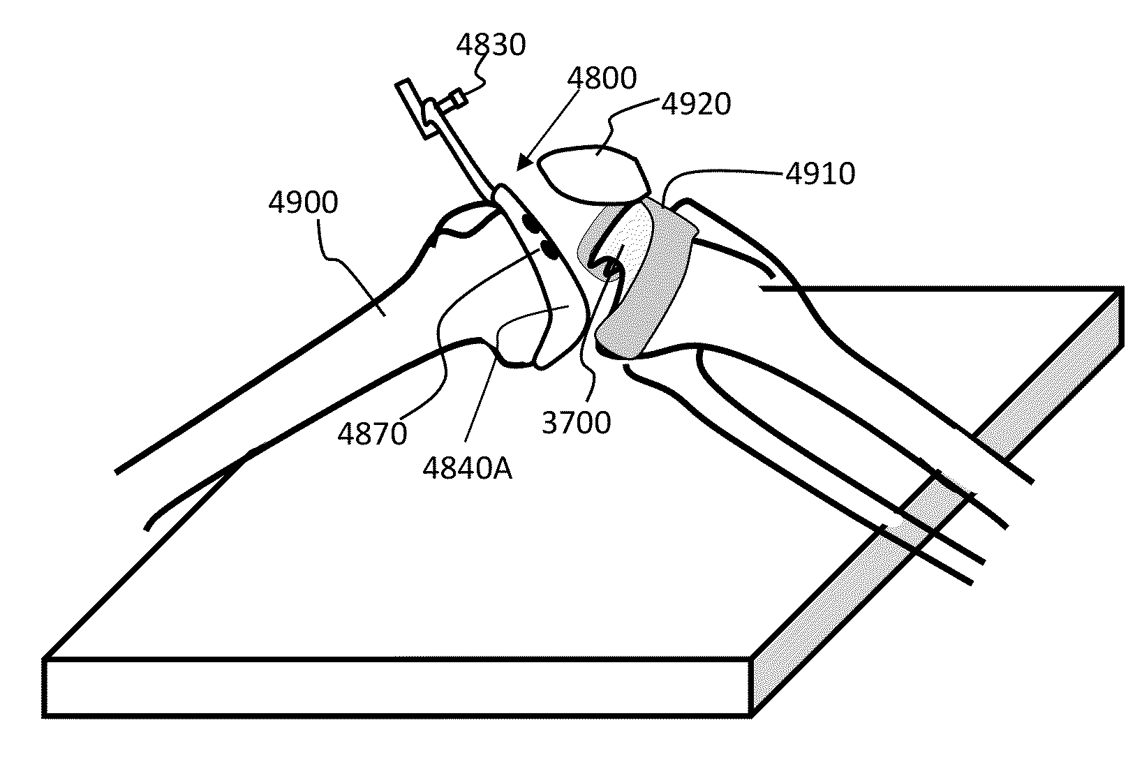 System and method for assessing, measuring, and correcting an anterior-posterior bone cut