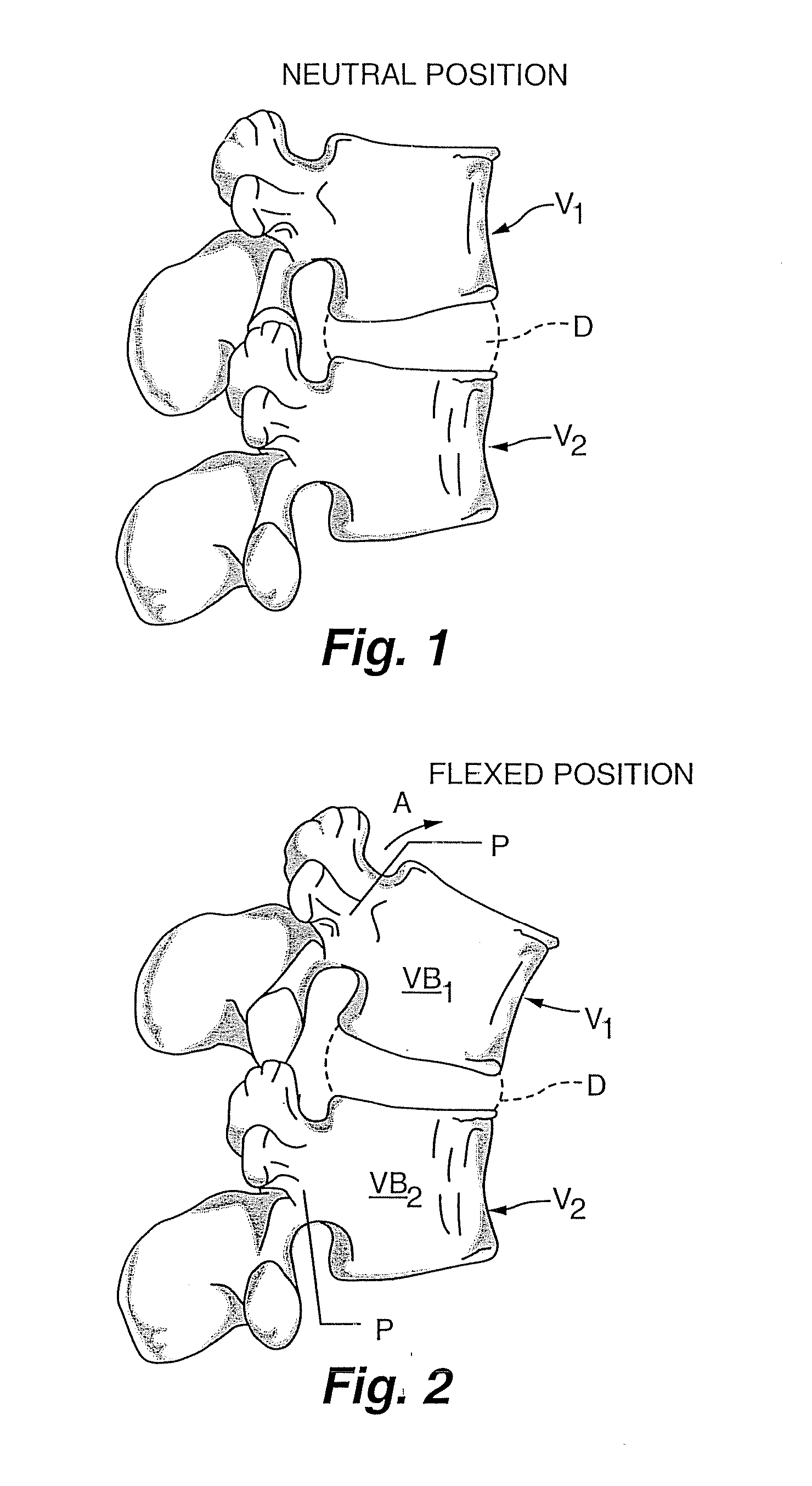 Dynamic fixation device and method of use