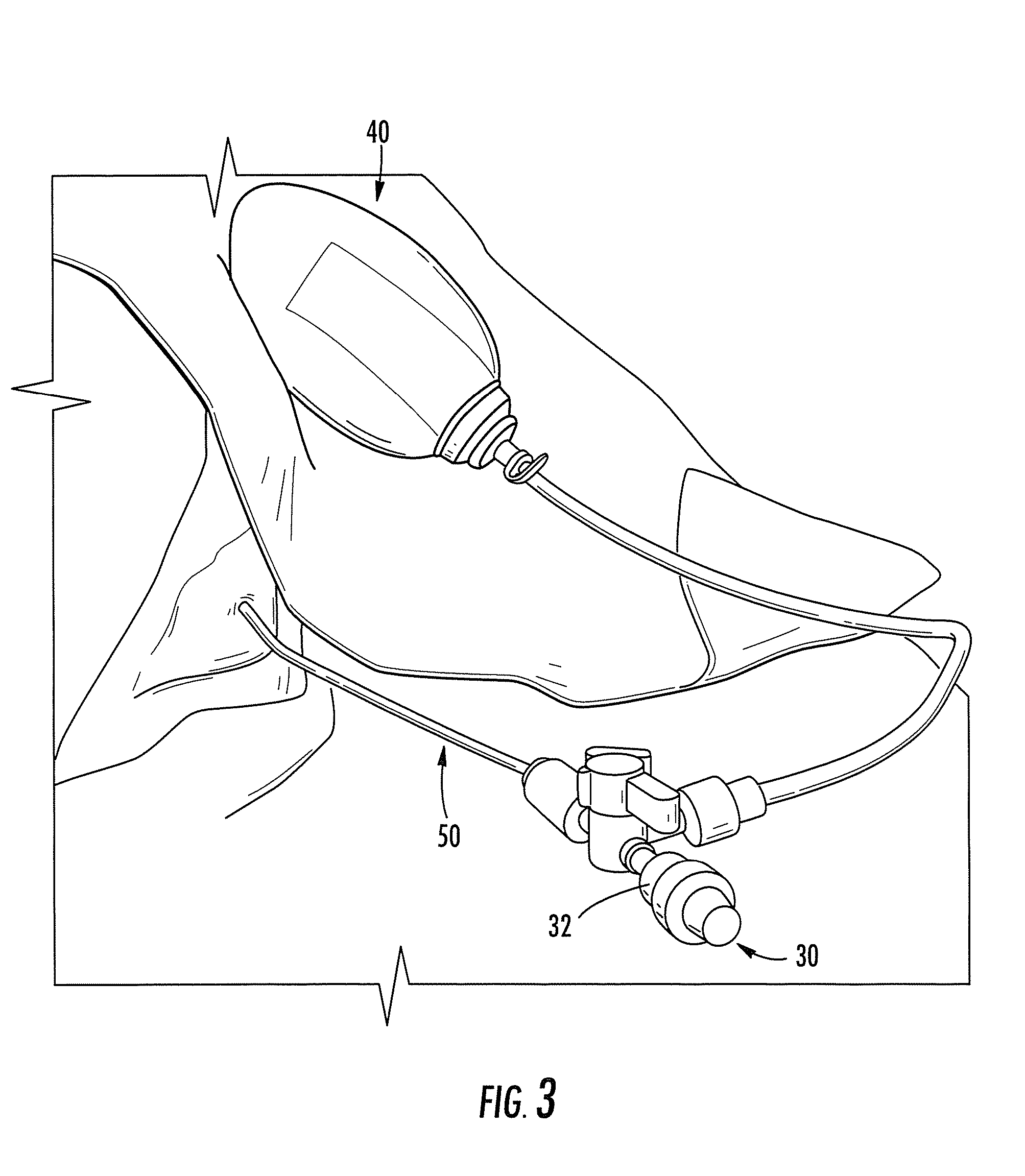 Subdural drainage catheter with flow restoration mechanism