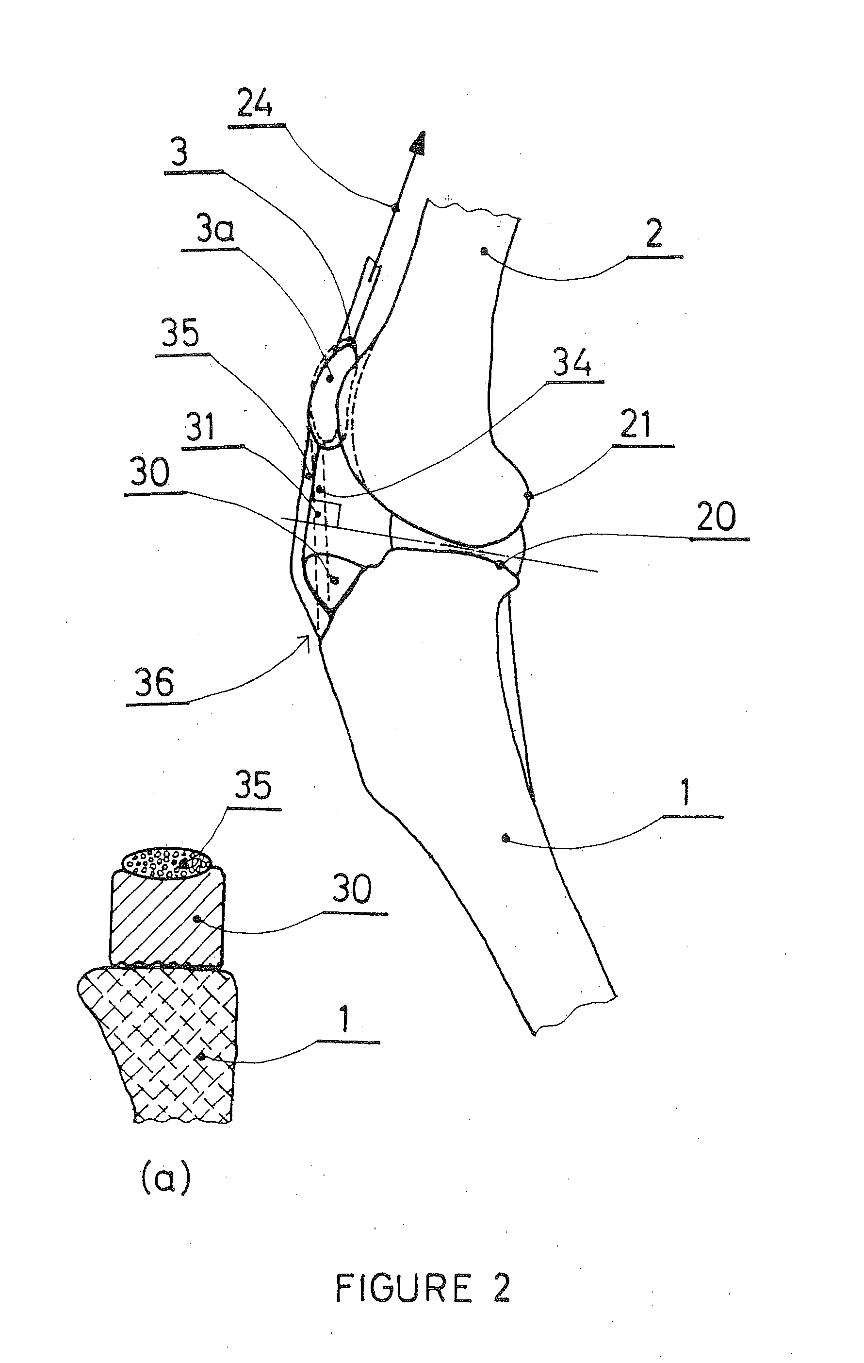 Patellar ligament spacer for acl injuries