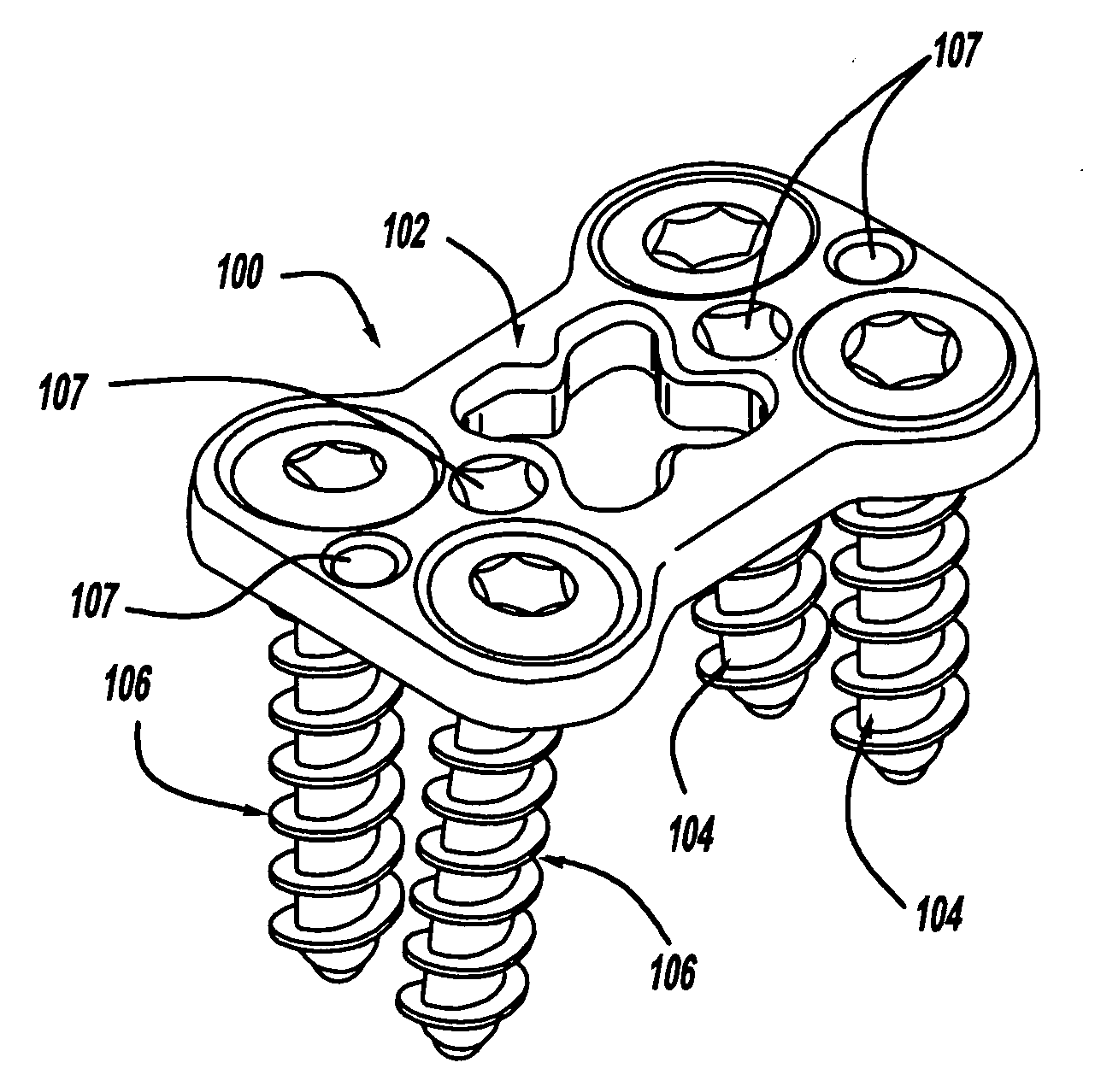 Bone fixation system