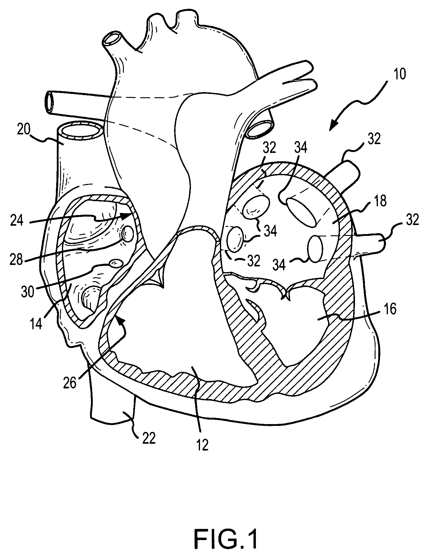 Ablation catheter electrode arrangement