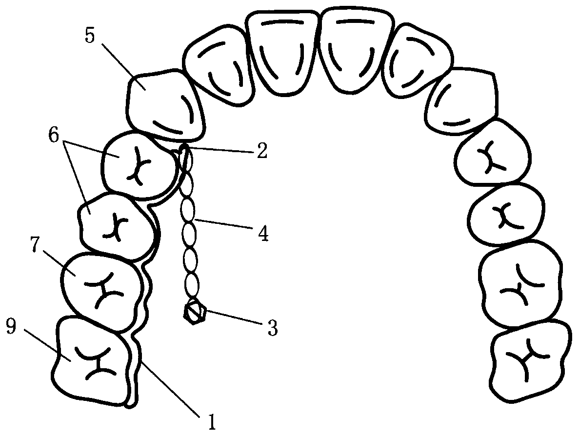 Molar back push device