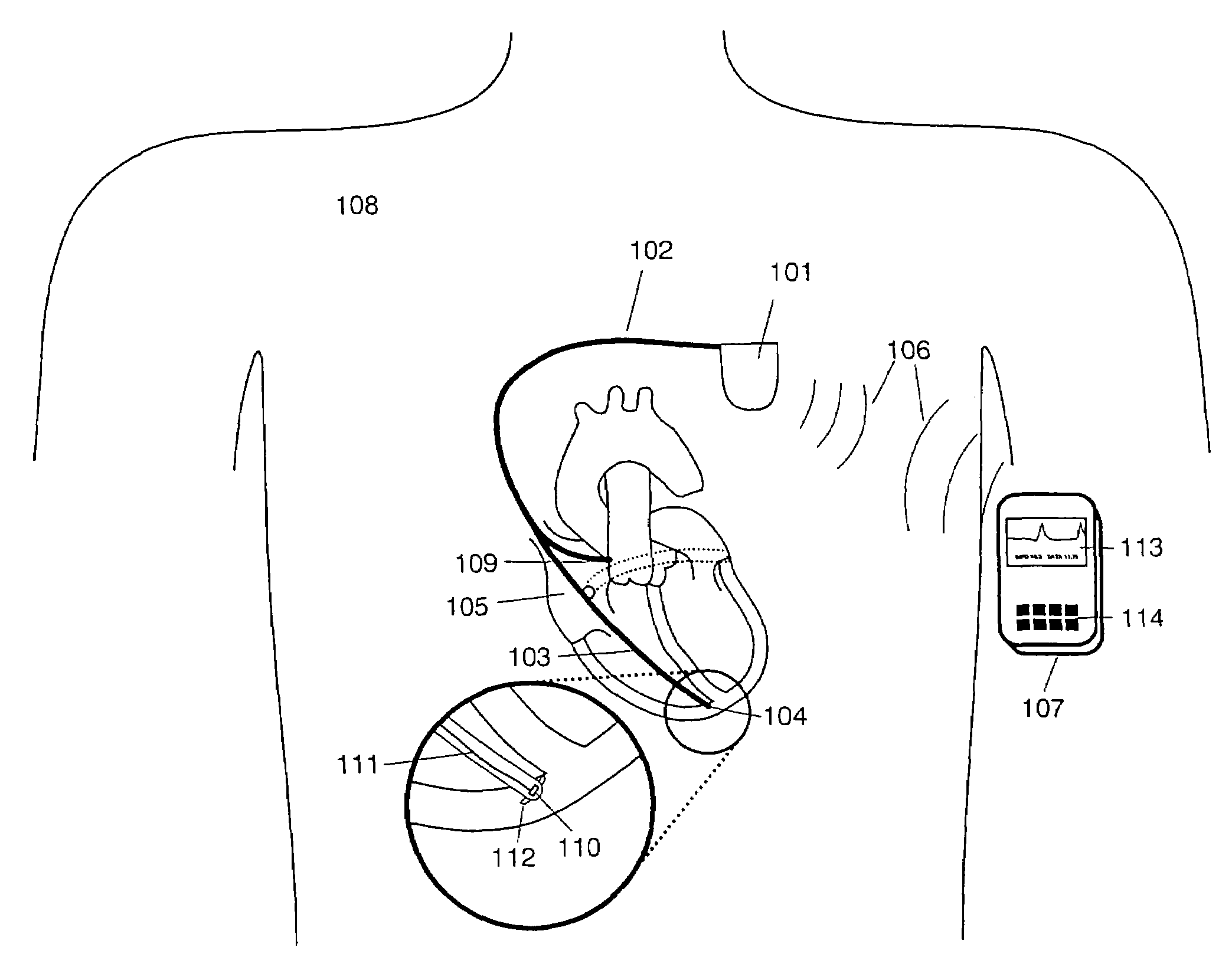 Detection of apex motion for monitoring cardiac dysfunction