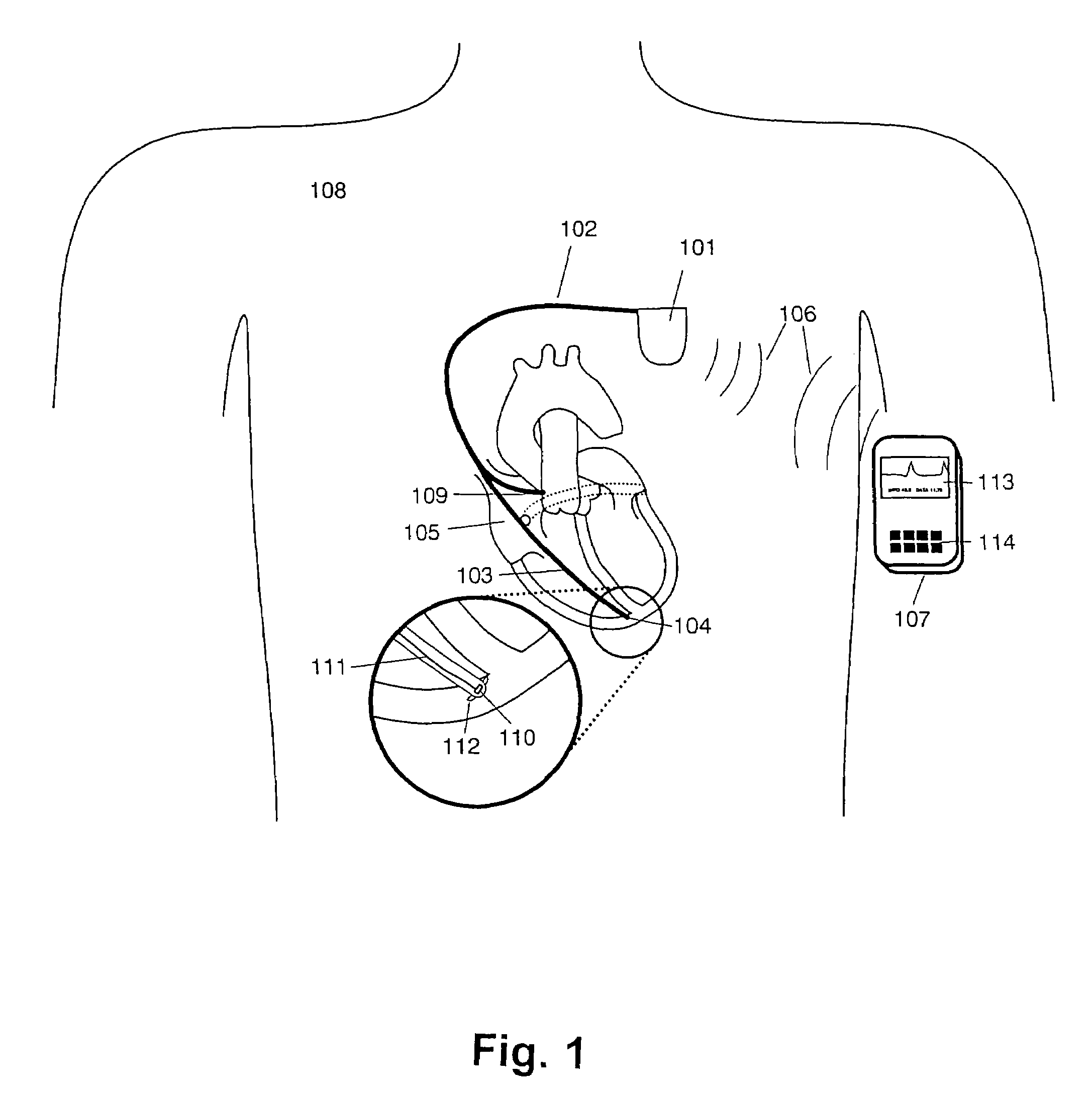 Detection of apex motion for monitoring cardiac dysfunction