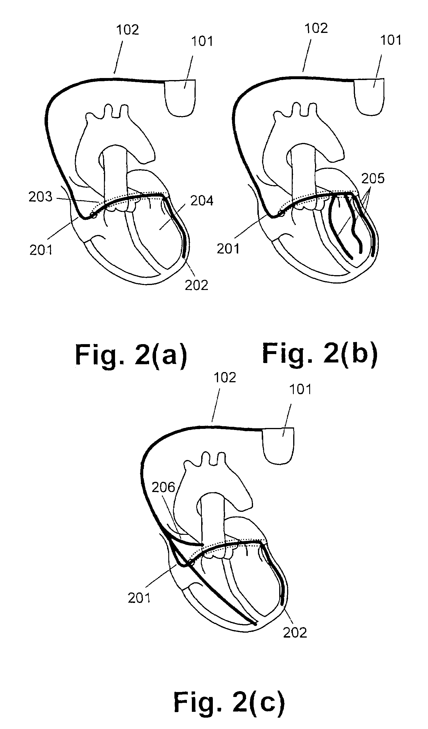 Detection of apex motion for monitoring cardiac dysfunction