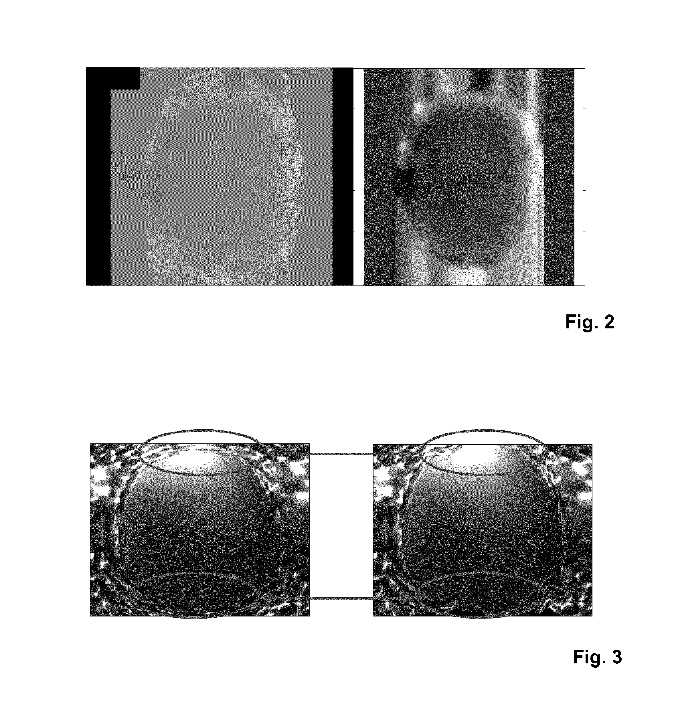 Parallel MRI with bo distortion correction and multi-echo dixon water-fat separation using regularised sense reconstruction