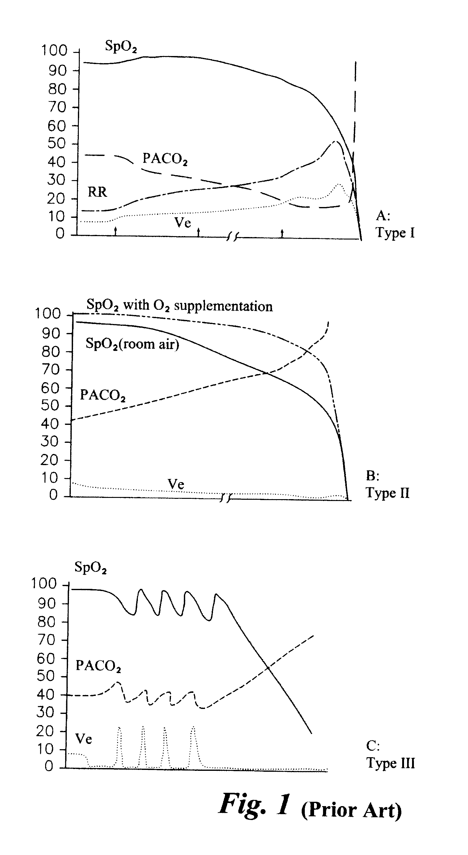 Respiratory stress detection