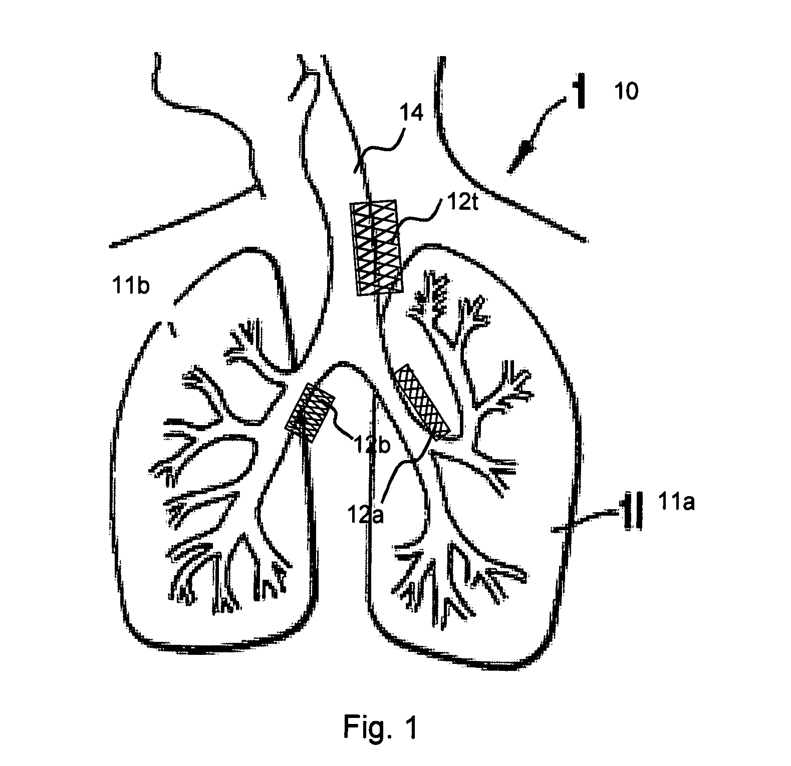 Therapeutic agent delivery for the treatment of asthma via implantable and insertable medical devices