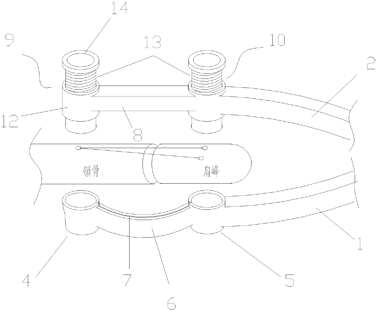 Acromioclavicular joint closed reduction suturing device