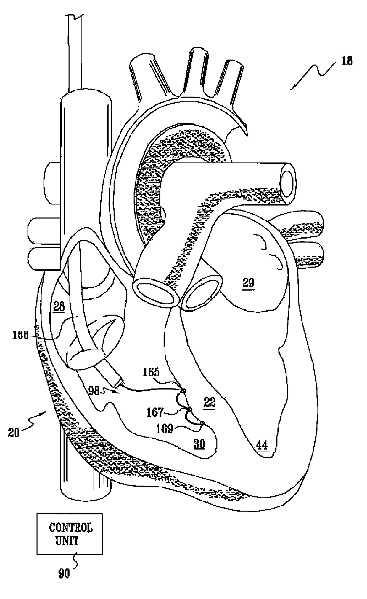 Signal delivery through the right ventricular septum