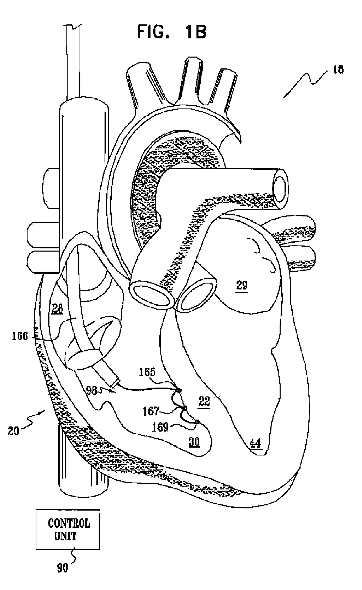 Signal delivery through the right ventricular septum