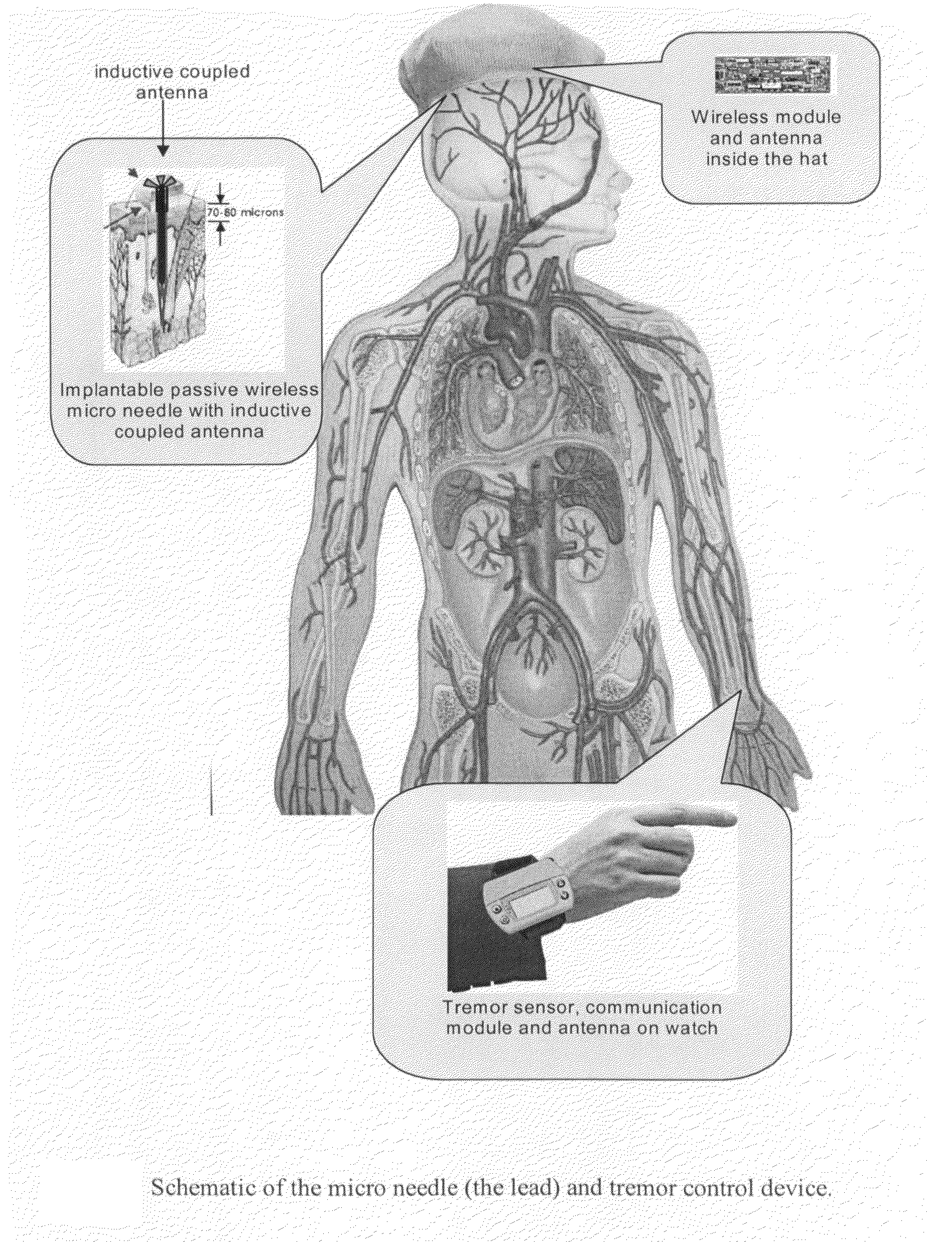 Methods and devices for treatment of medical conditions and monitoring physical movements