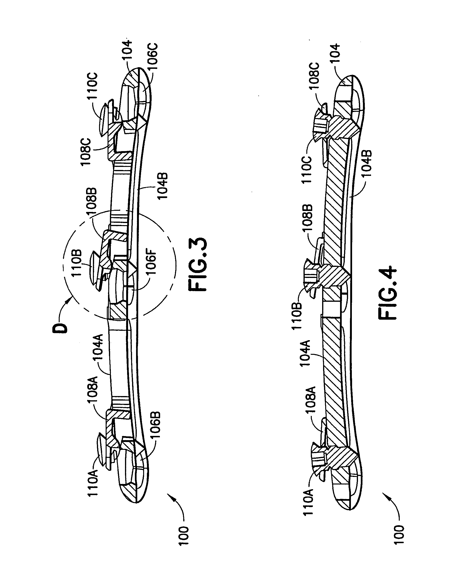 Anterior cervical plating system