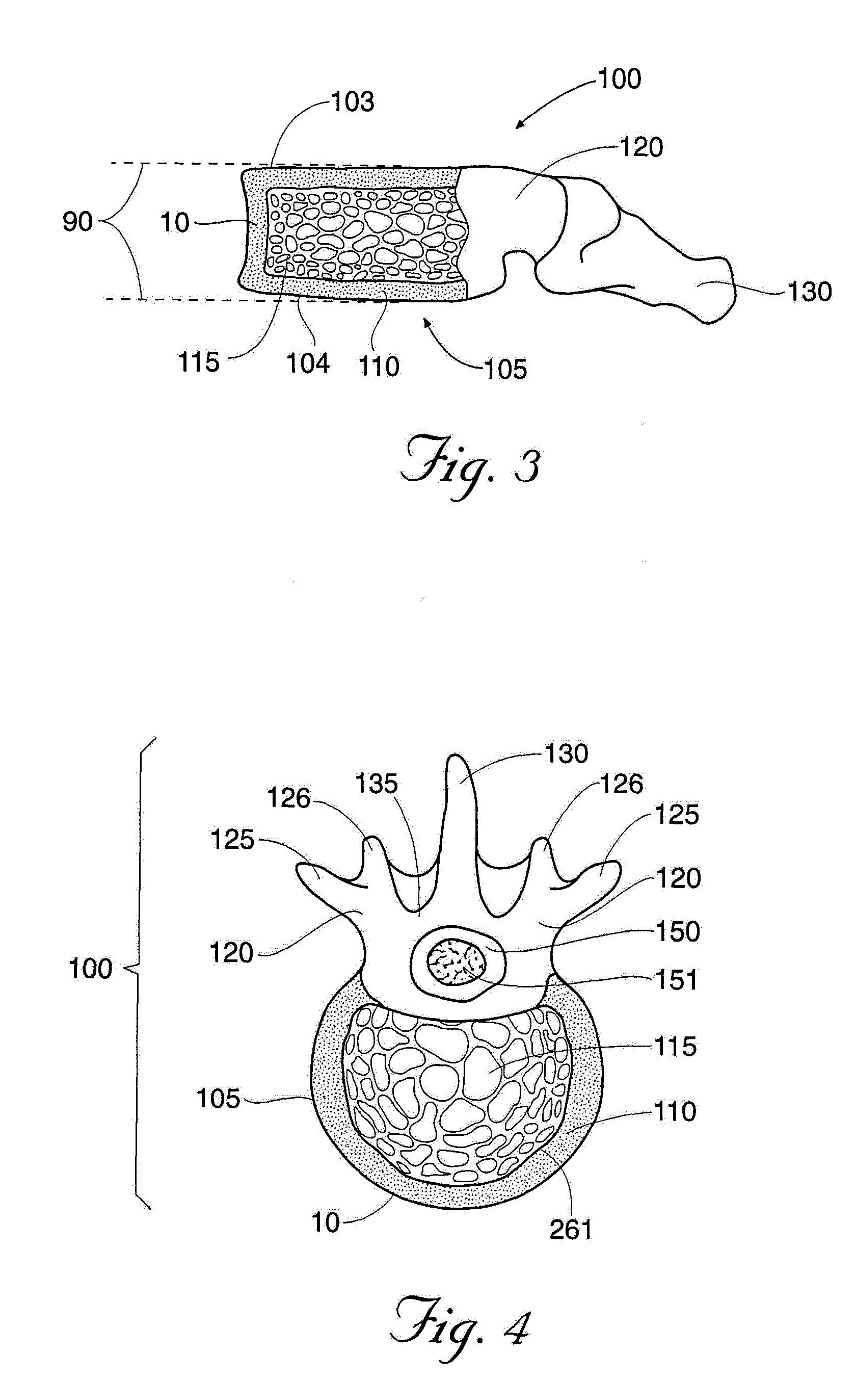 Methods and devices for treating fractured and/or diseased bone