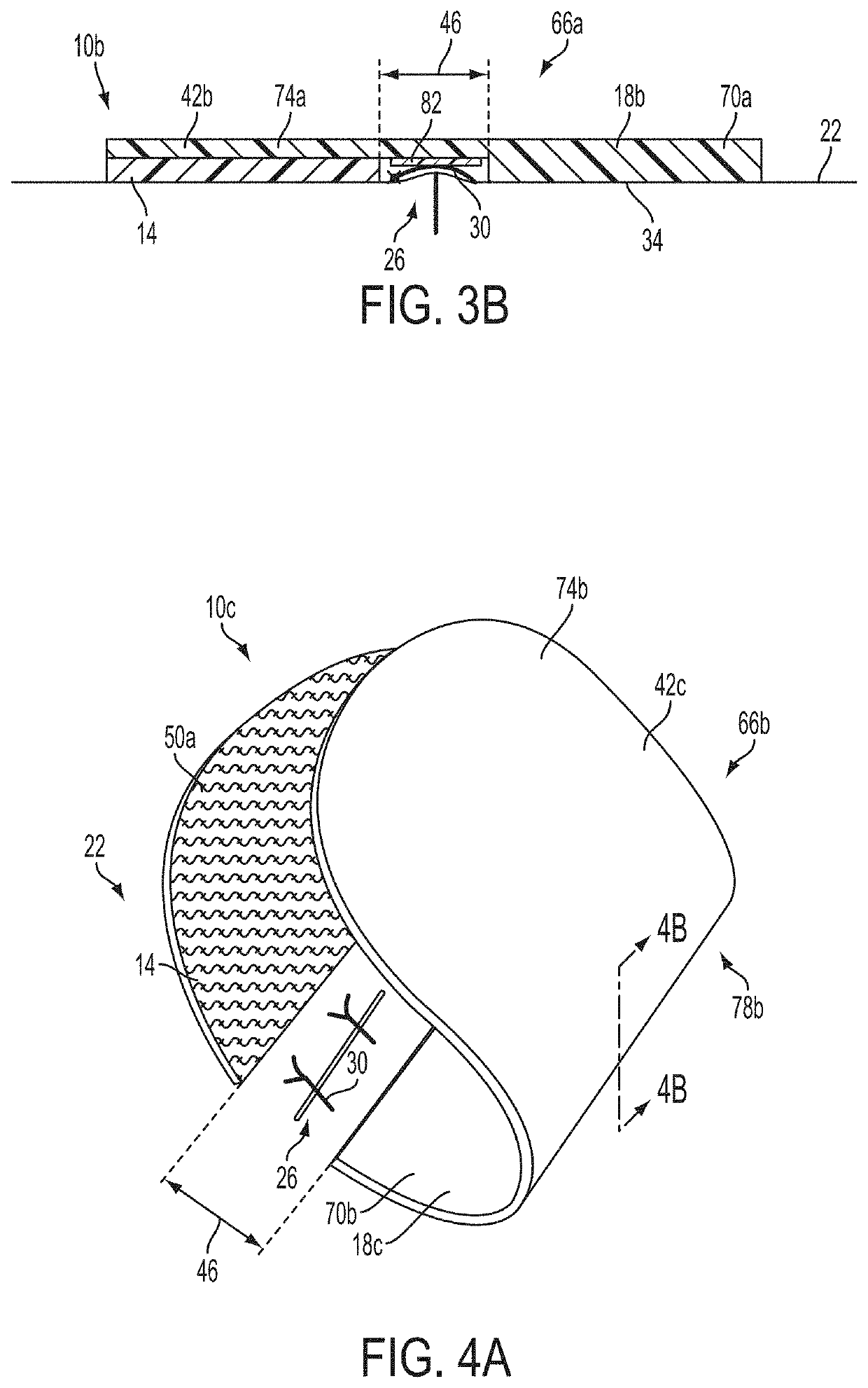 Apparatuses and methods for minimizing wound dehiscence, scar spread, and/or the like