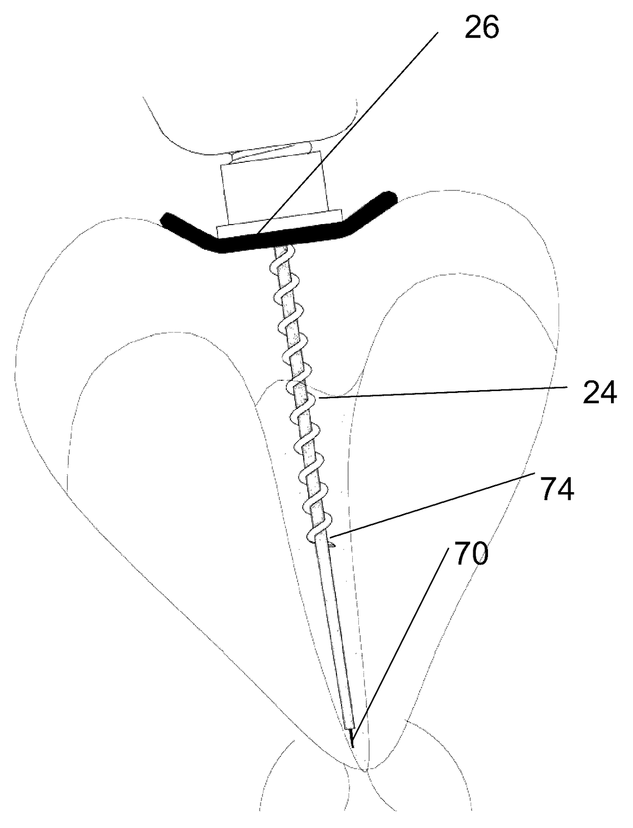 Root canal treatment