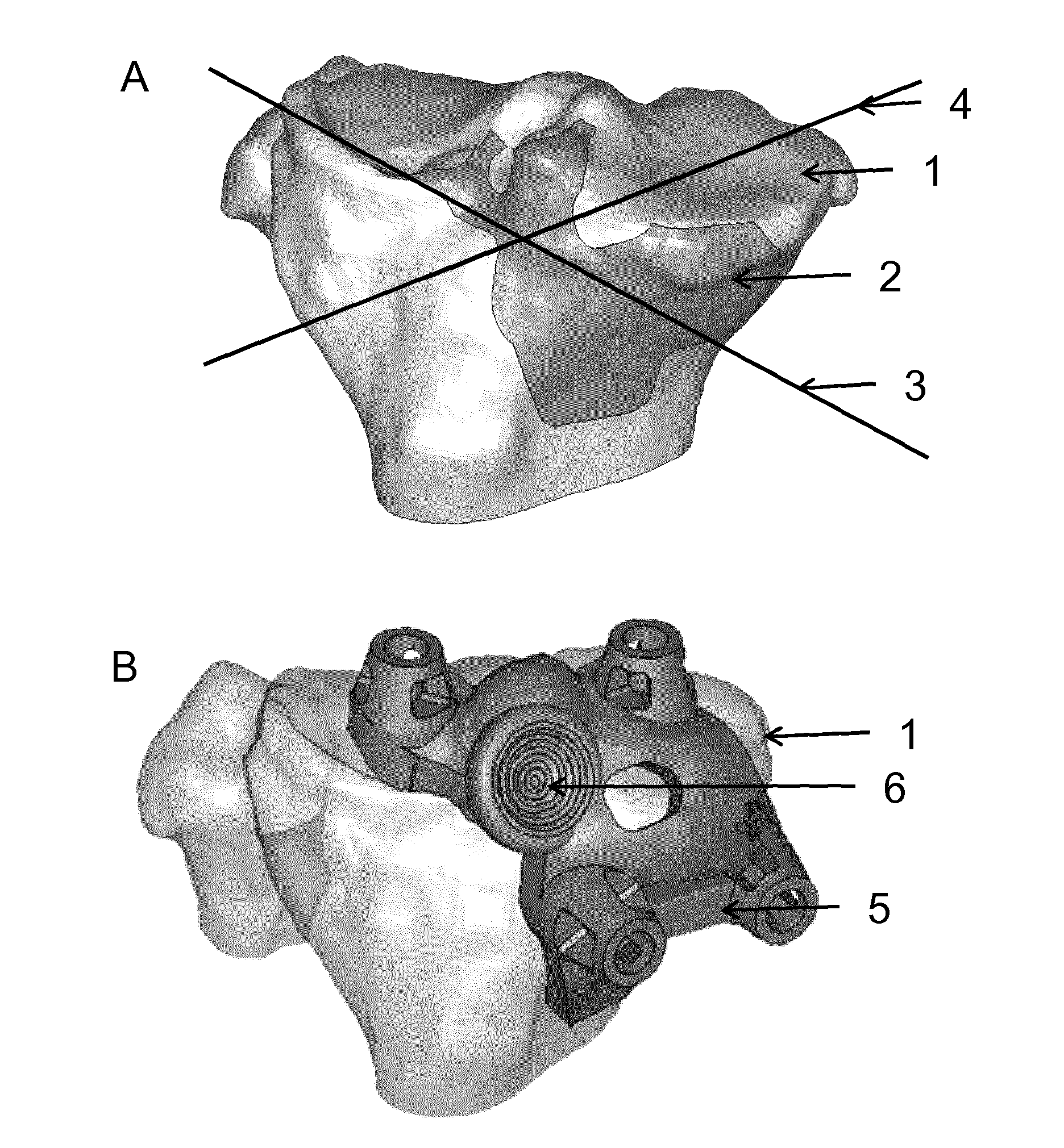 Guides with pressure points