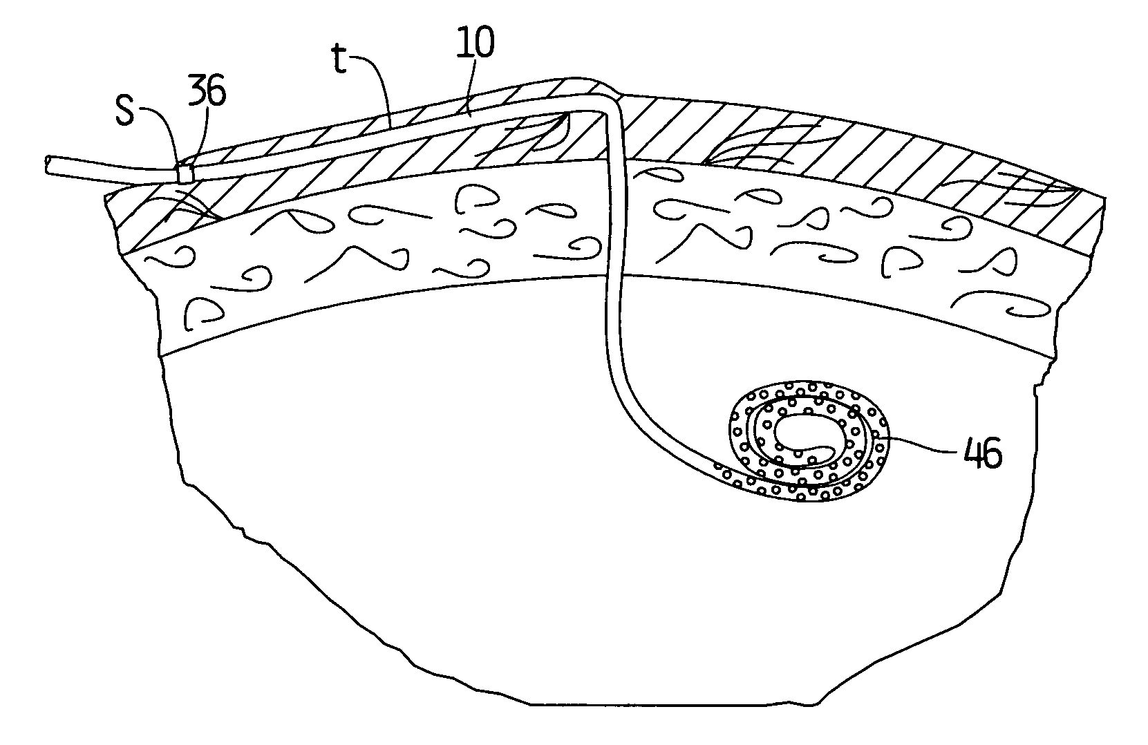 Peritoneal dialysis catheter and insertion method