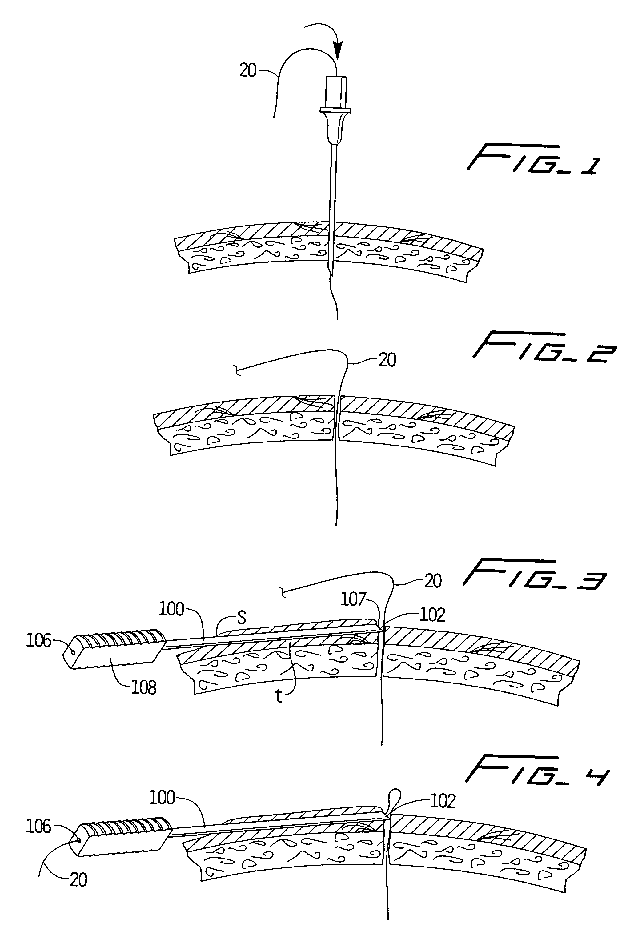 Peritoneal dialysis catheter and insertion method