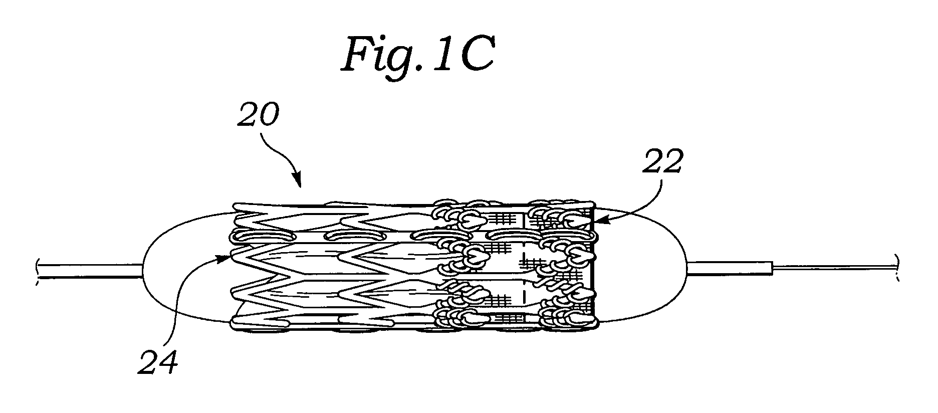 System for deploying balloon-expandable heart valves