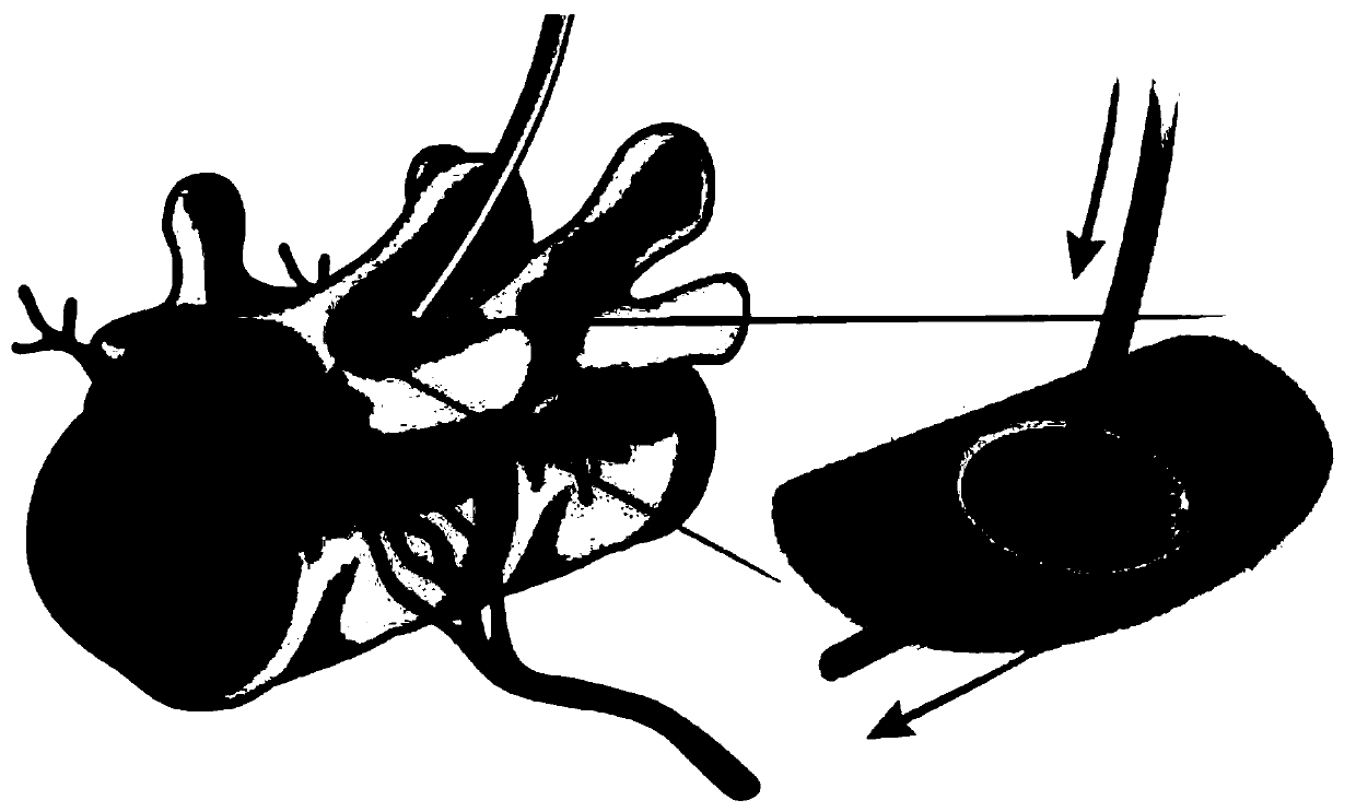 Method and composition for treating neuropathic pain