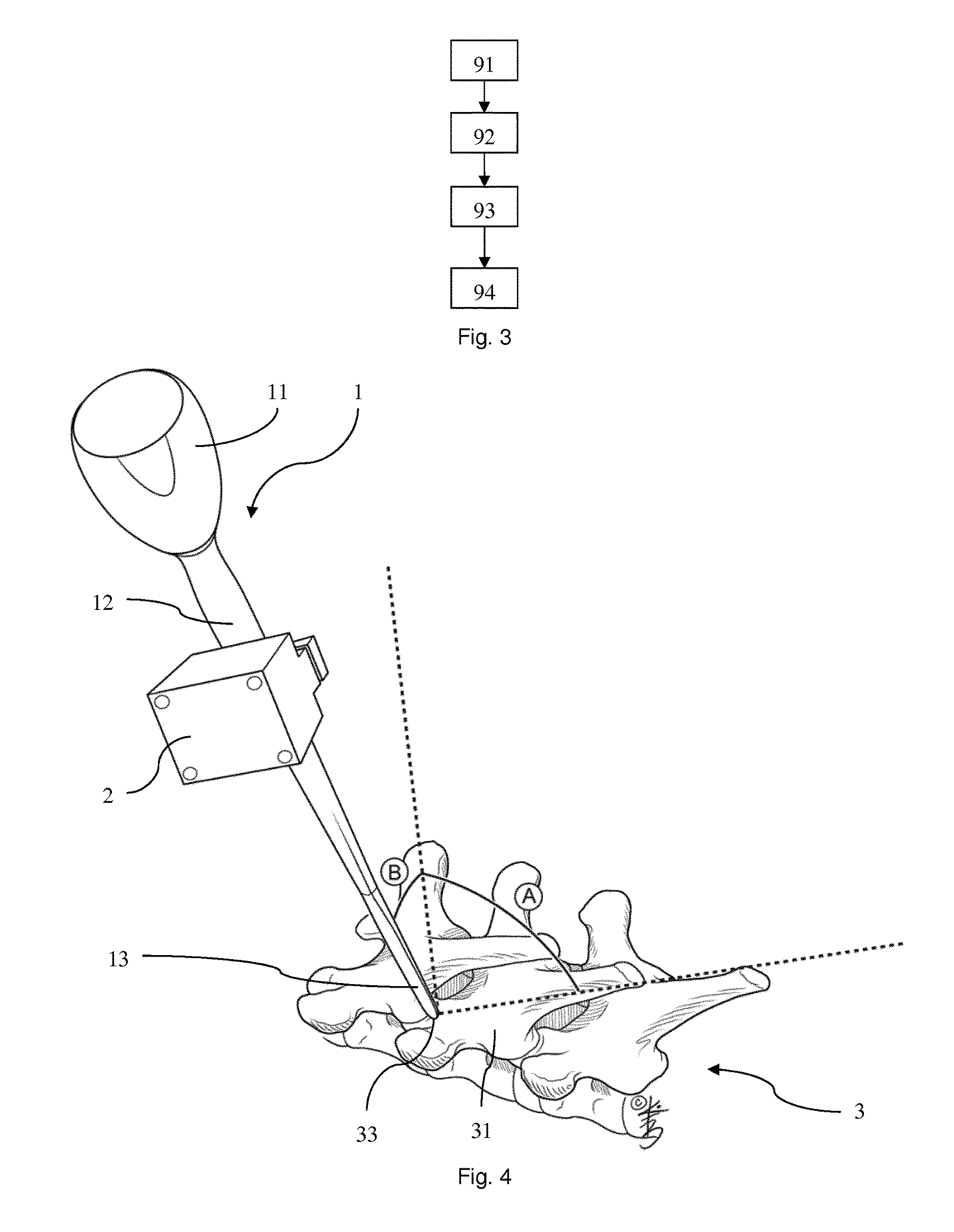 Controlling a surgical intervention to a bone