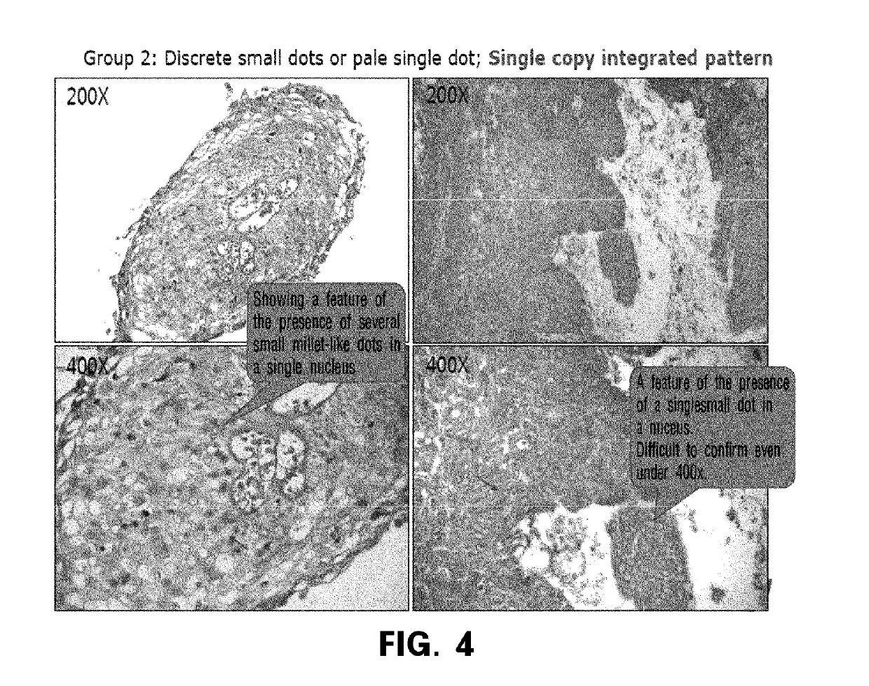 Method for prediction of prognosis by human papillomavirus DNA integration pattern