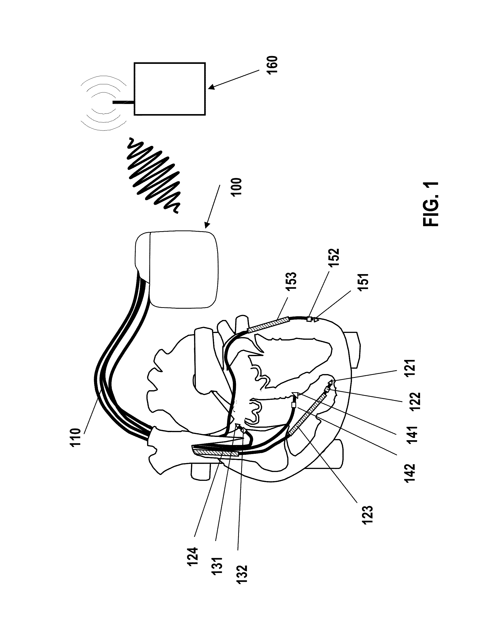 Cardiac stimulator for cardiac contractility modulation