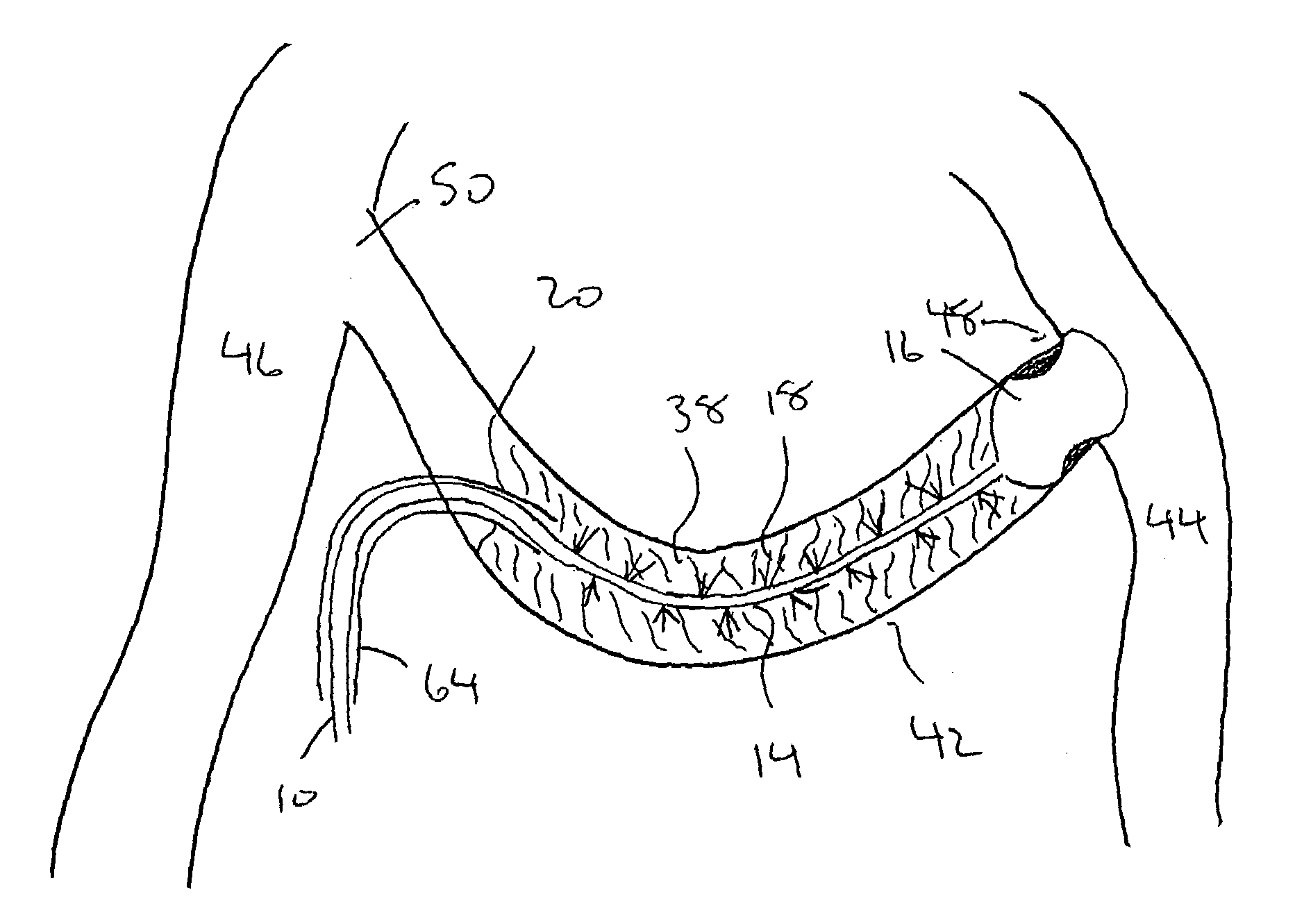 Method and apparatus for treatment of thrombosed hemodialysis access grafts