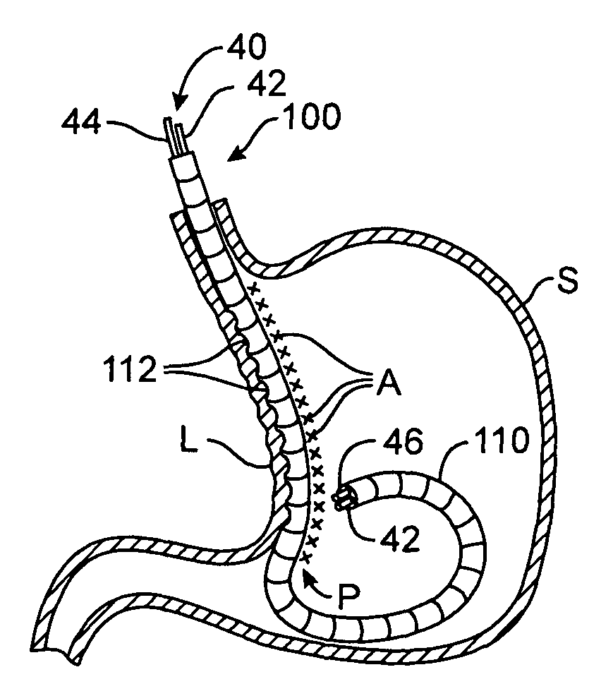 Methods and apparatus for performing endoluminal gastroplasty