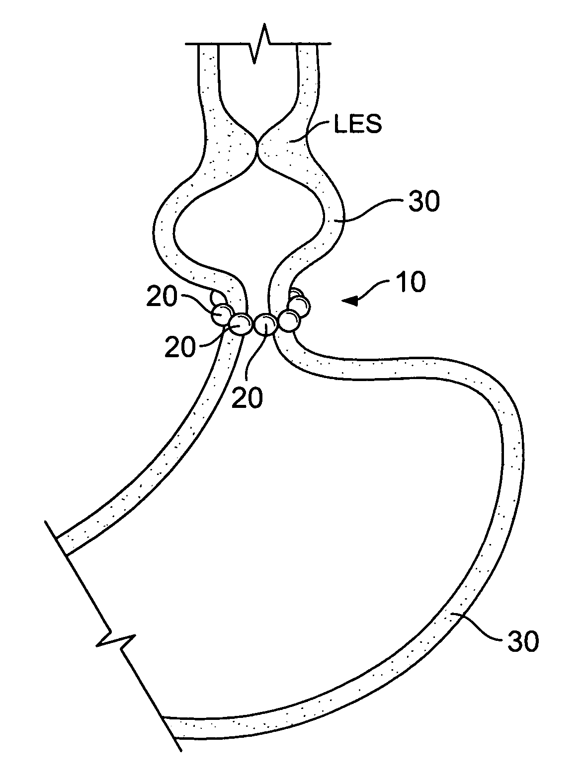 Magnetic gastric band or the like, and related methods