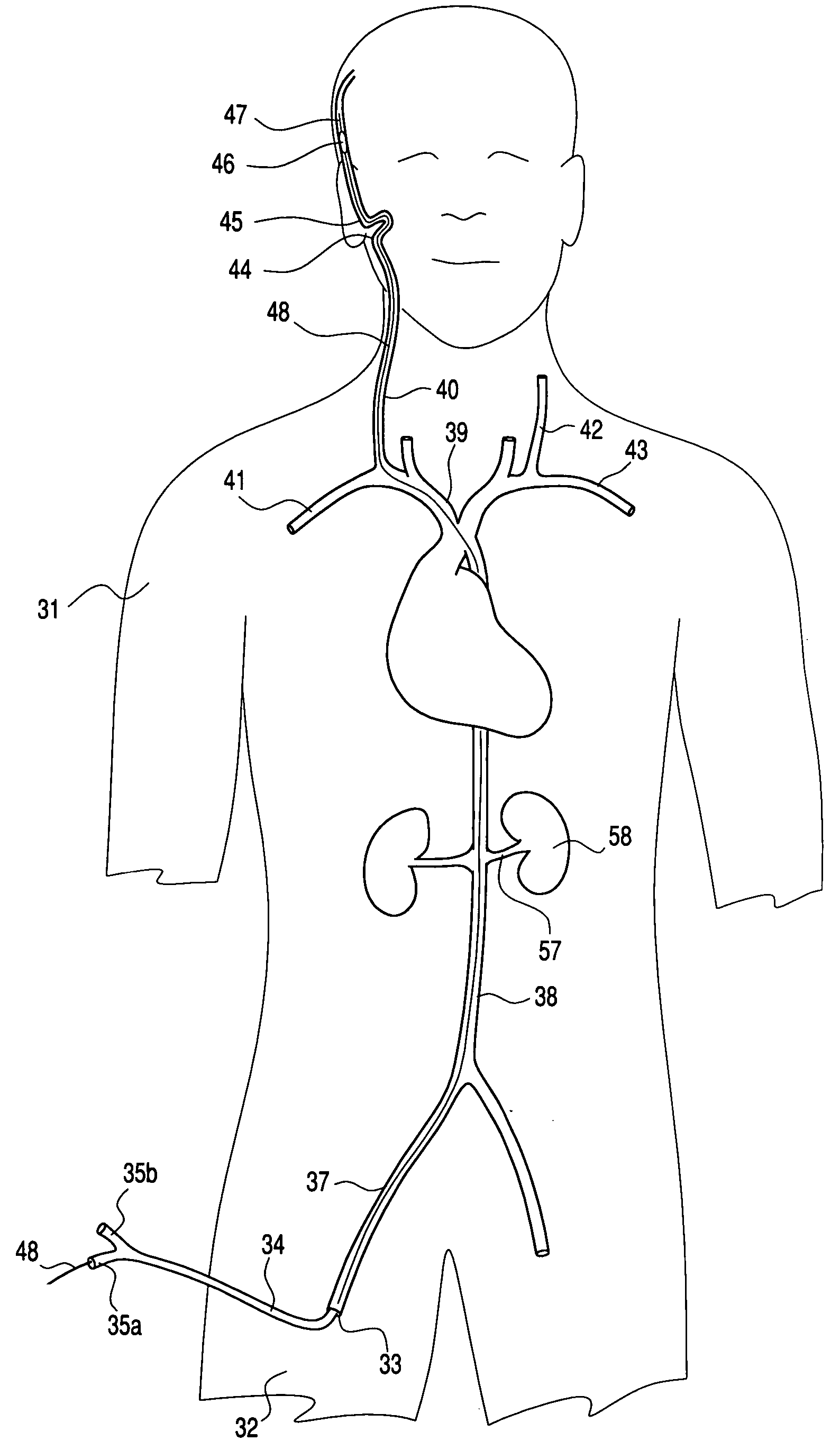 Transluminal application of adult stem cells for body organ tissue repair