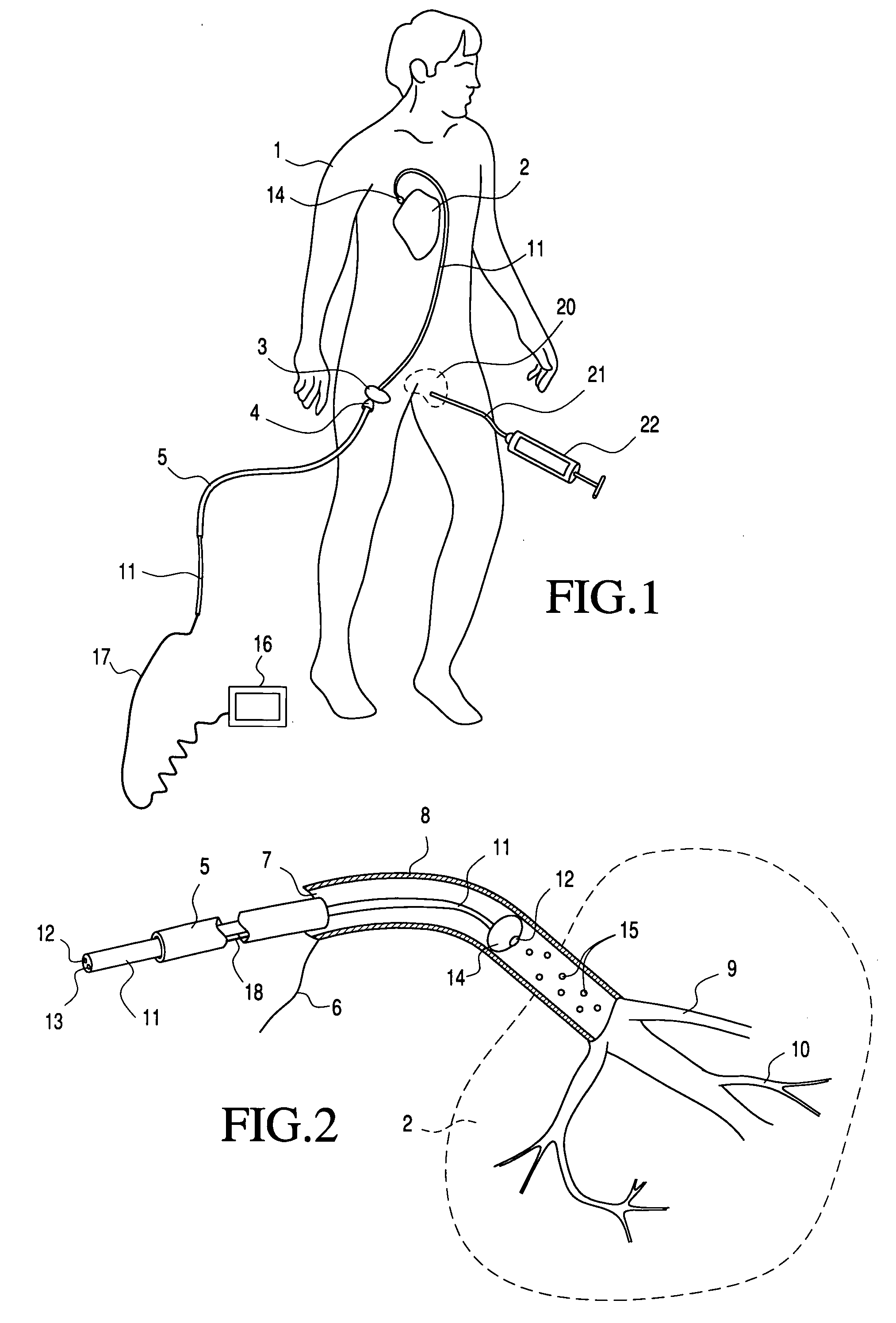 Transluminal application of adult stem cells for body organ tissue repair