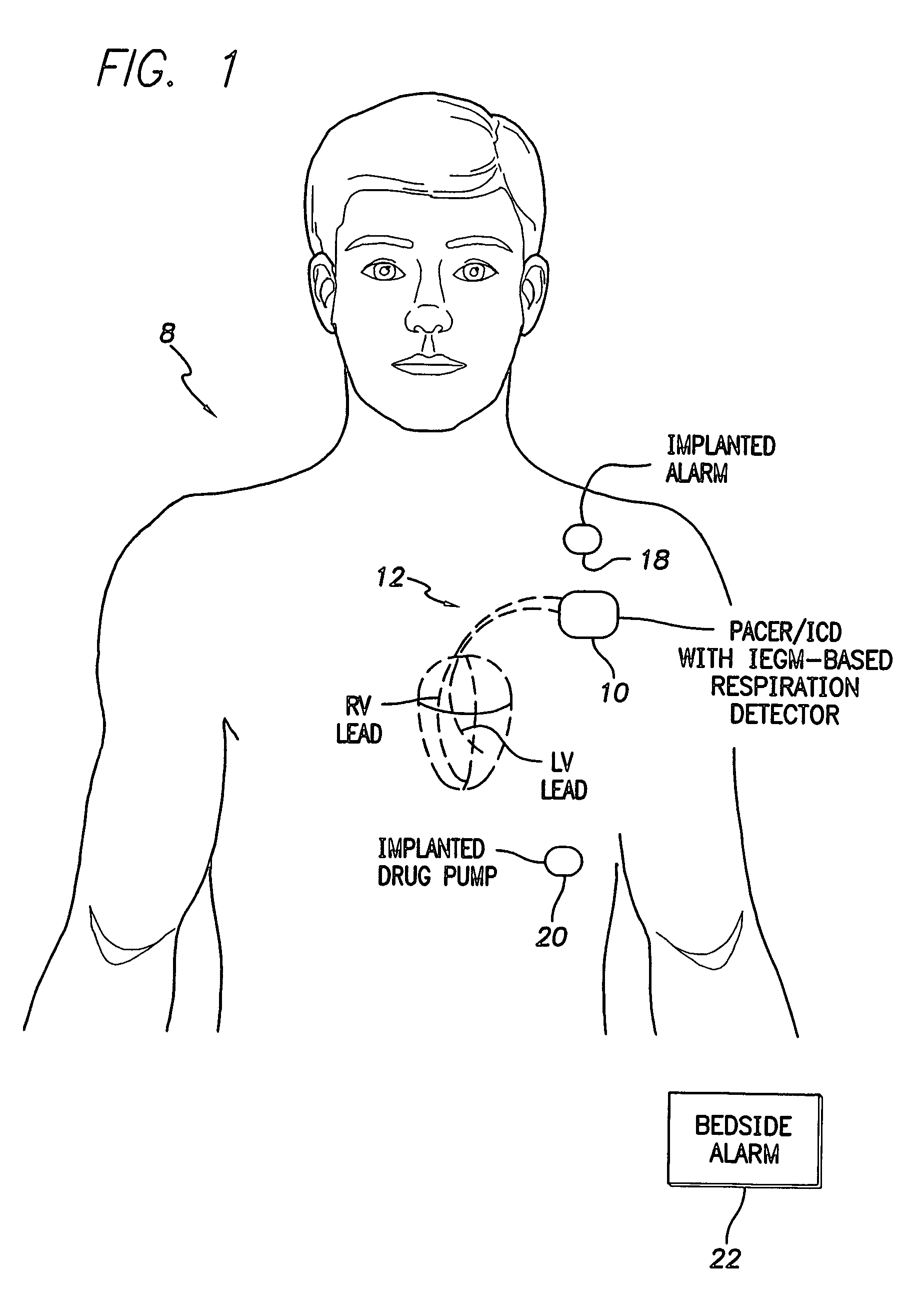 System and method for detecting abnormal respiration via respiratory parameters derived from intracardiac electrogram signals