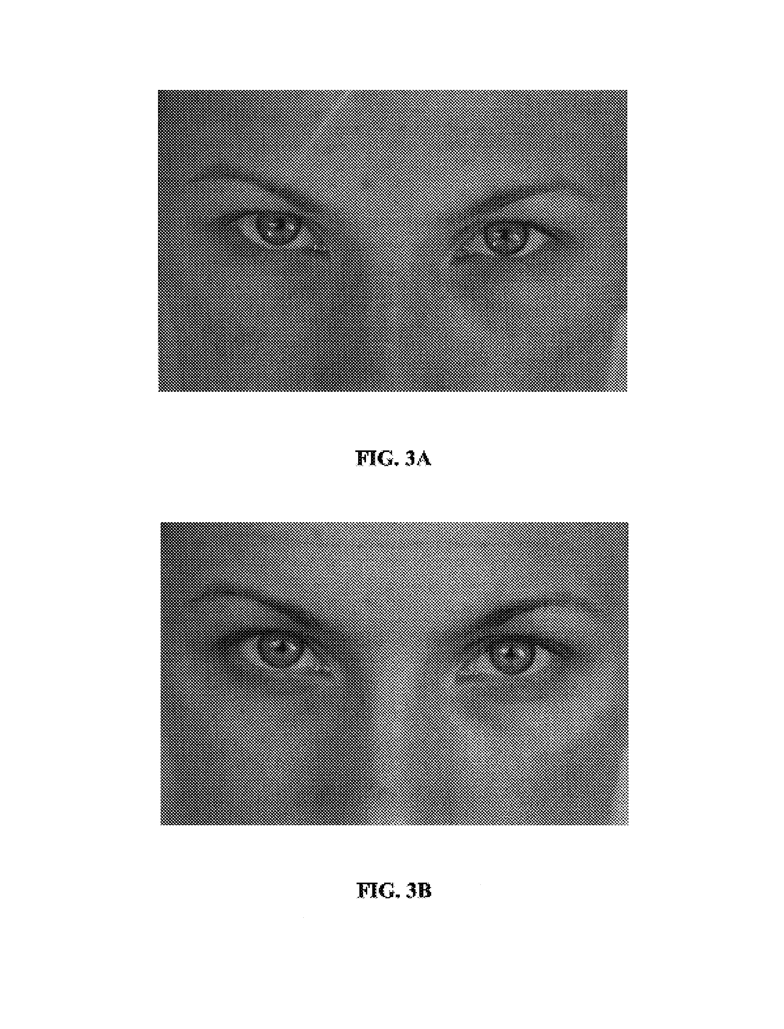 Compositions and methods for treatment of skin discoloration