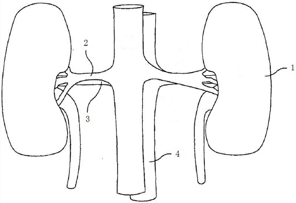 Renal artery radiofrequency ablation catheter