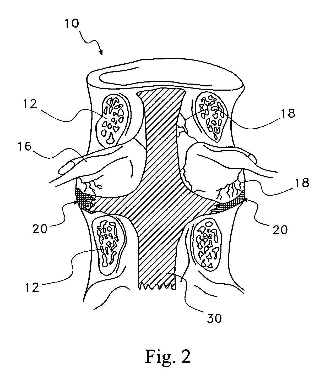 Methods for treating back or neck pain caused by NGF using a therapeutic agent consisting of ReN-1820, ALE-0540 and capsaicin