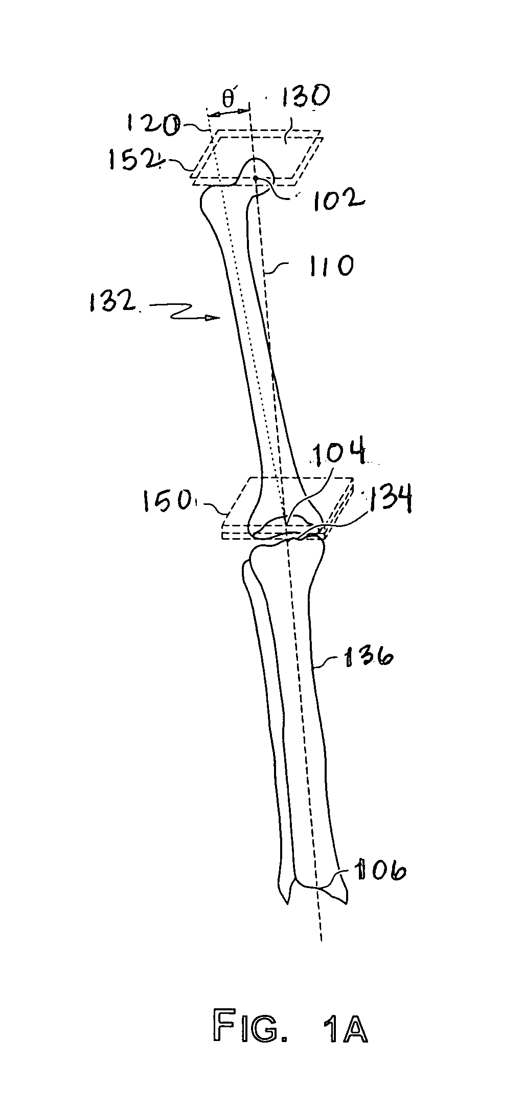 Surgical tools facilitating increased accuracy, speed and simplicity in performing joint arthroplasty