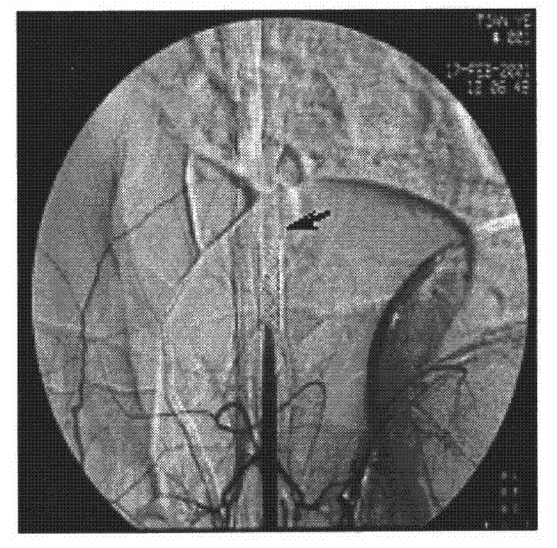 Preparation method for radioactivity TiNi alloy bracket without fringe effect