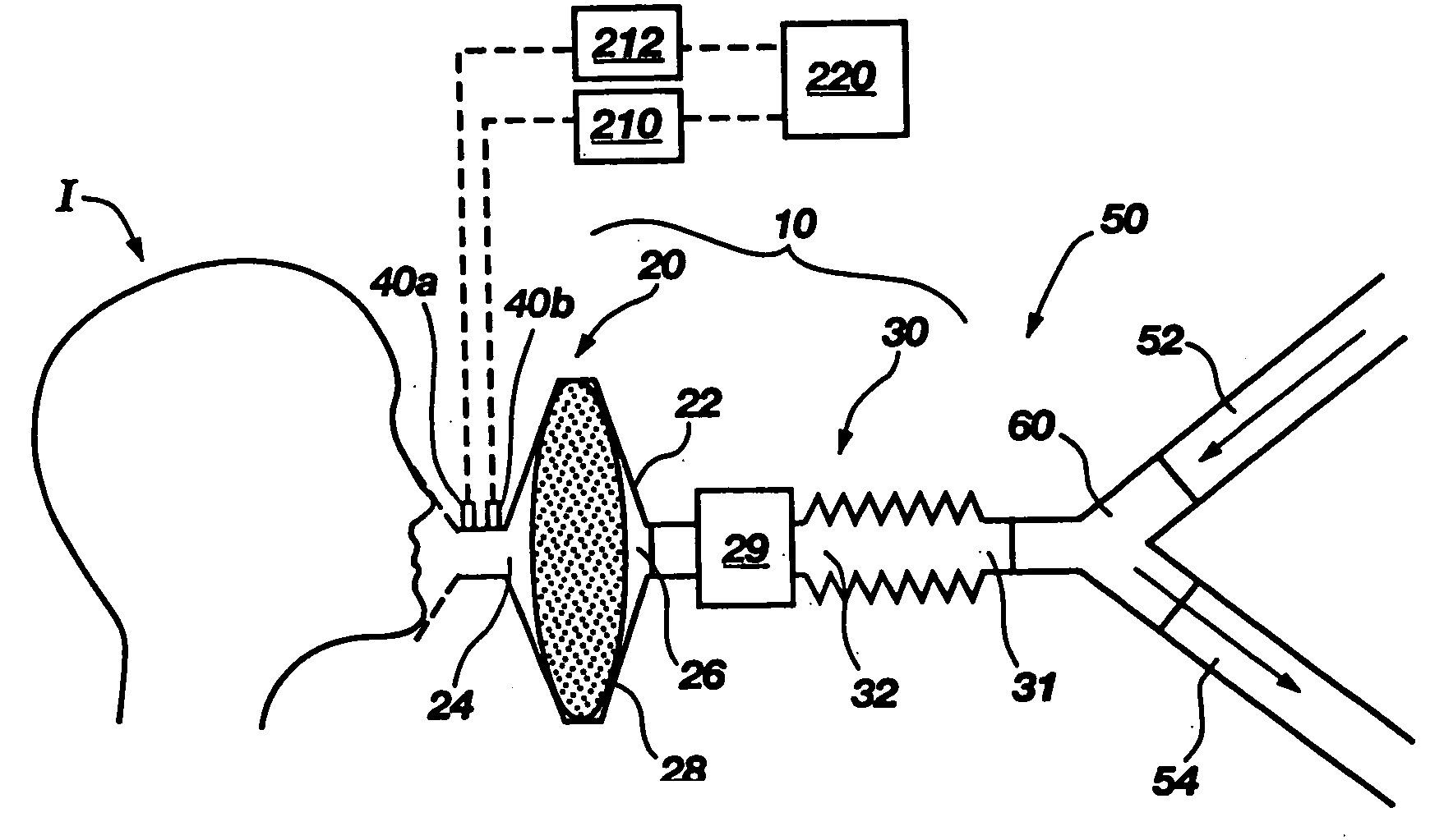 Apparatus and techniques for reducing the effects of general anesthetics