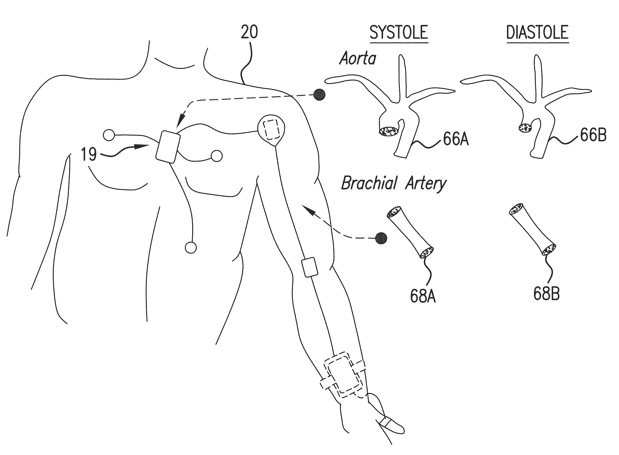 Body-worn system for continuous, noninvasive measurement of cardiac output, stroke volume, cardiac power, and blood pressure