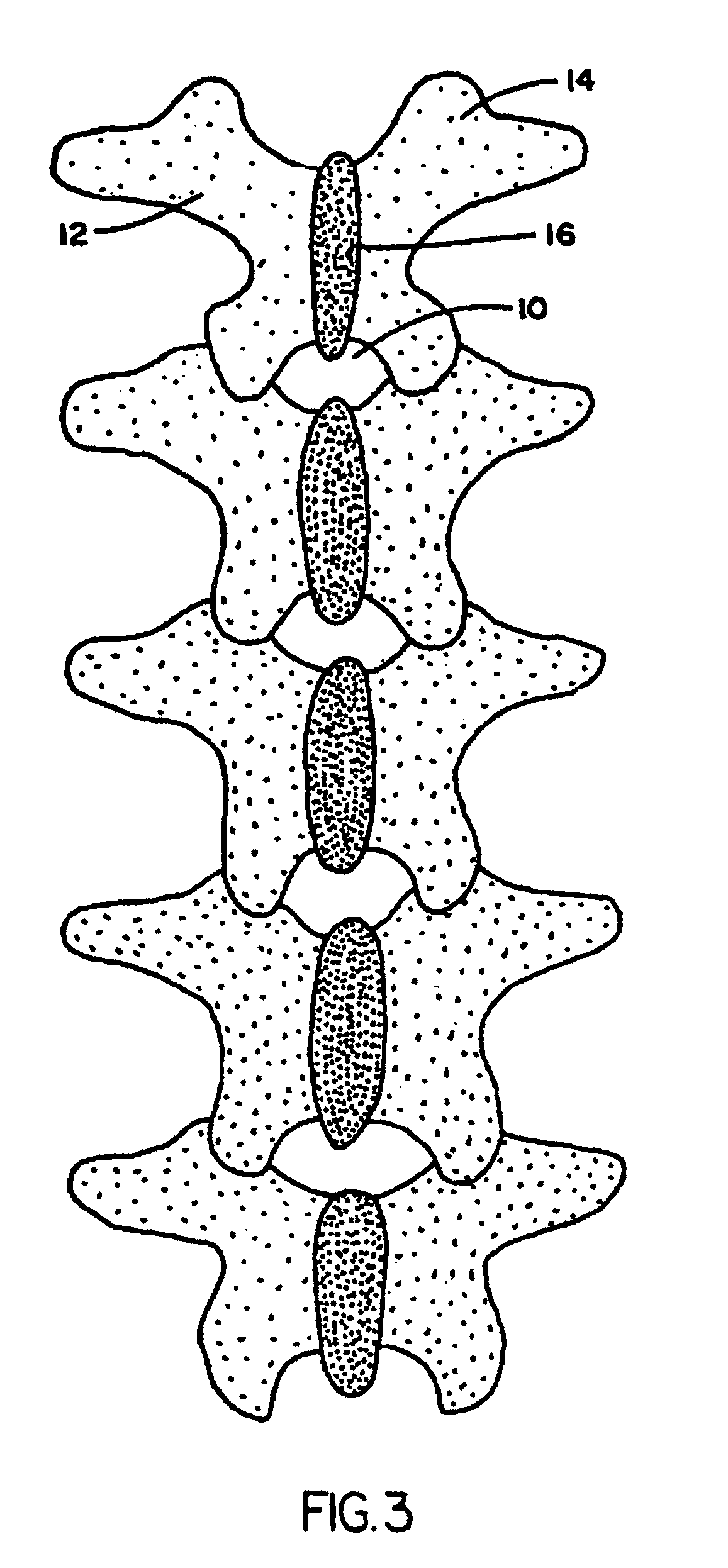 Polyaxial pedicle screw having a rotating locking element