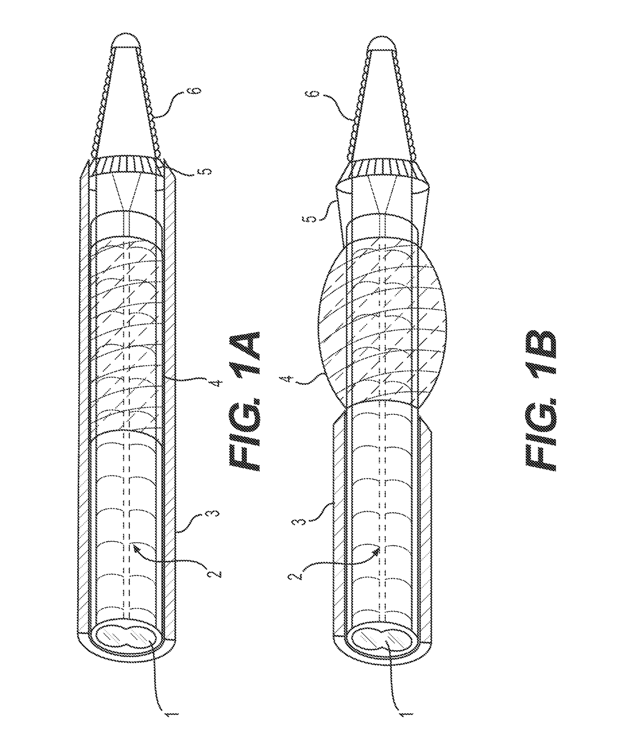 Devices and methods for treating occlusion of the ophthalmic artery