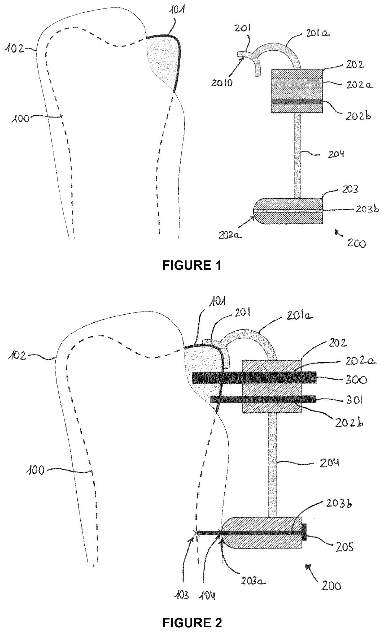 Patient-specific surgical guide