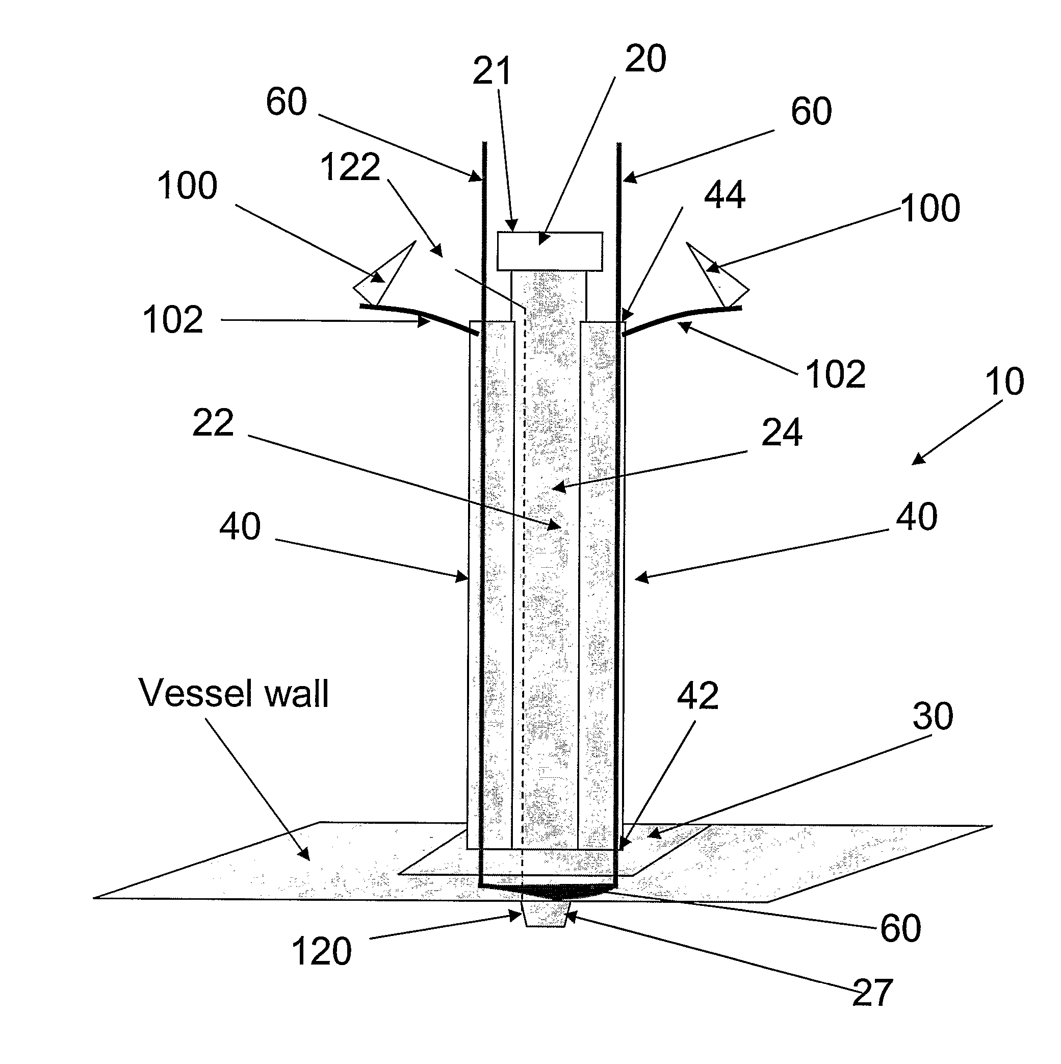 Cardioplegia Catheter System