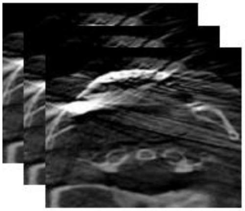 Data Fusion Method of Oral CBCT Image and Laser Scanning Teeth Mesh