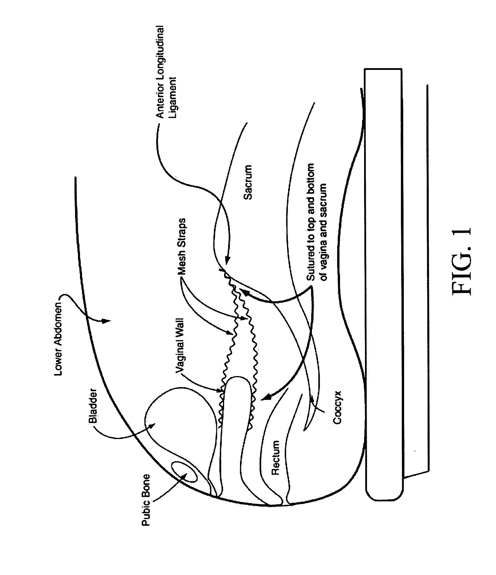 Endoscopic mesh delivery system with integral mesh stabilizer and vaginal probe